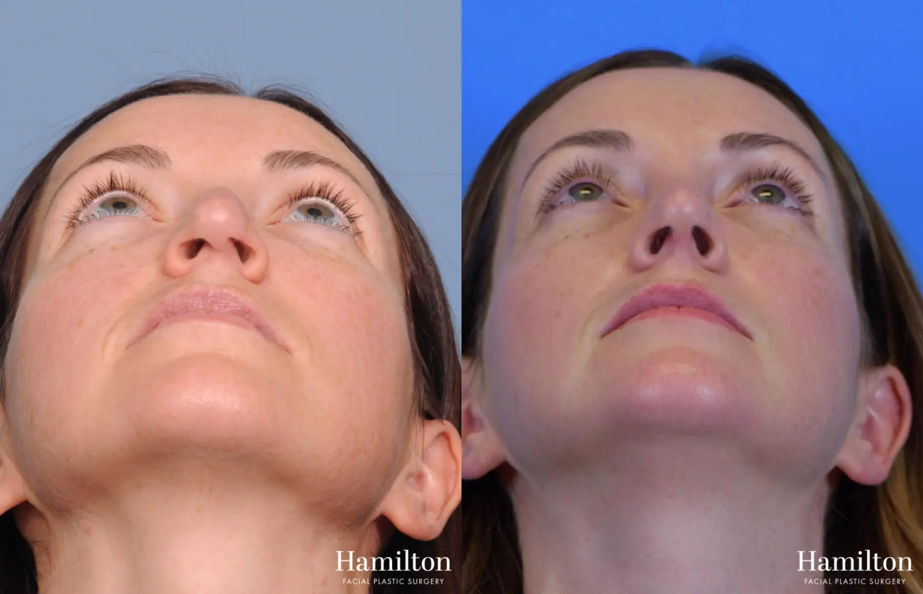Rhinoplasty: Patient 8 - Before and After 5
