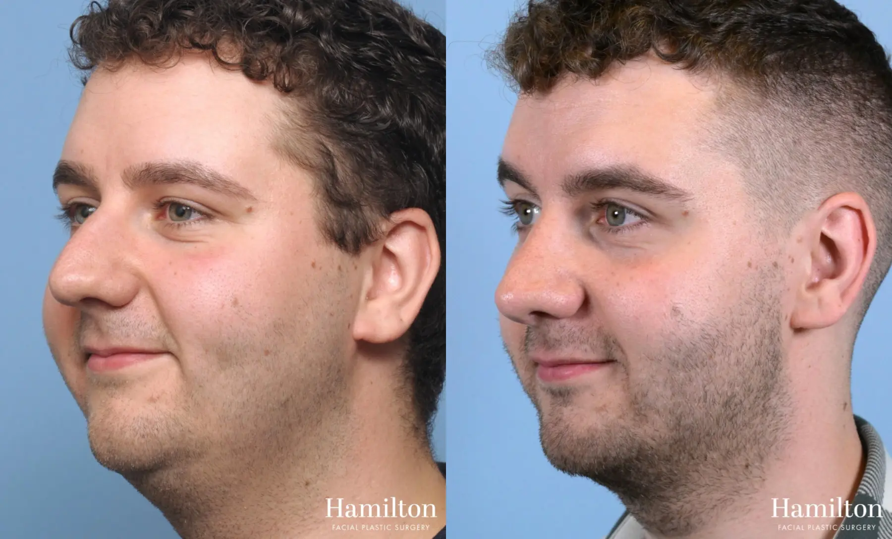 Rhinoplasty: Patient 10 - Before and After 4