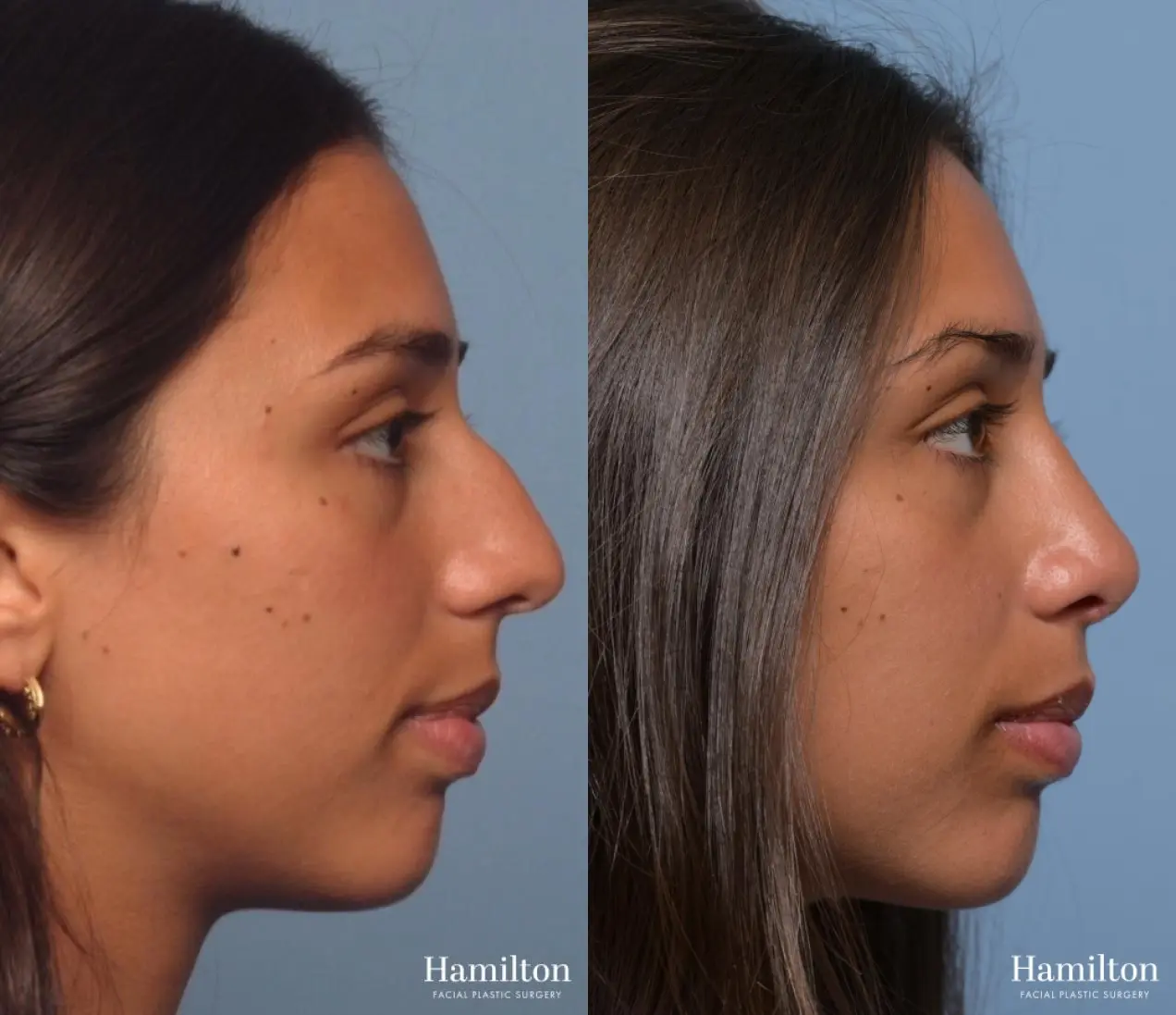 Rhinoplasty: Patient 2 - Before and After  