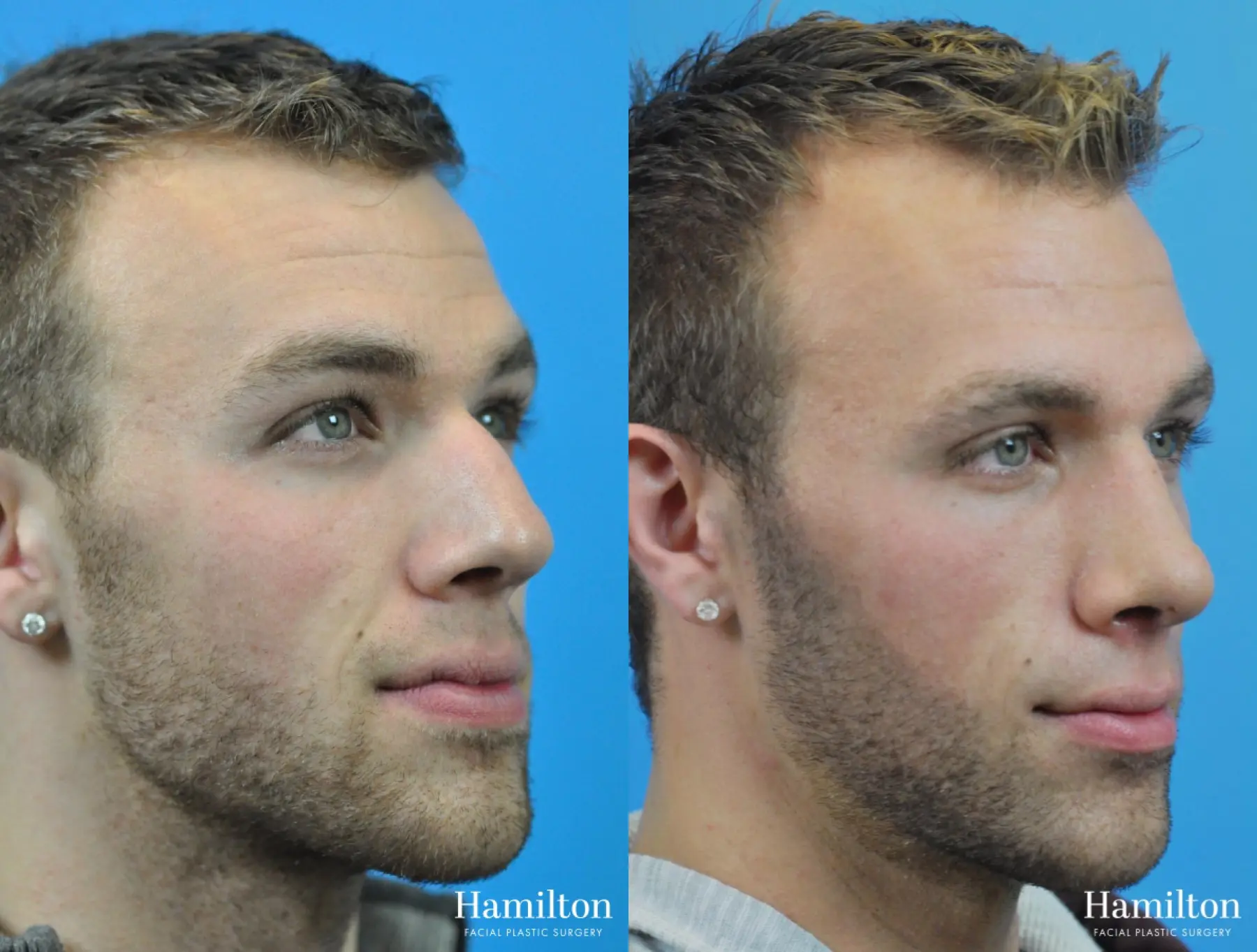 Rhinoplasty: Patient 7 - Before and After 3