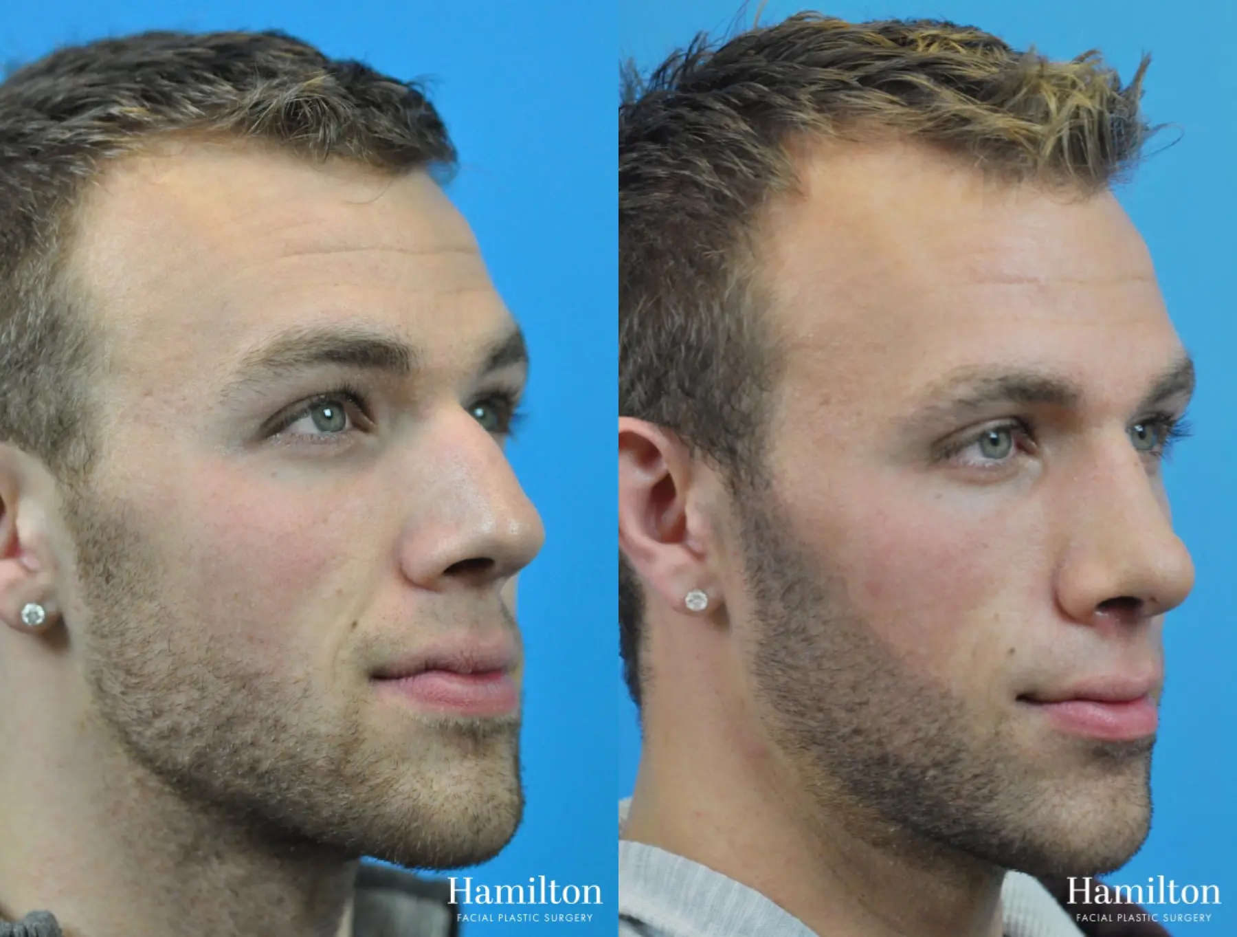 Rhinoplasty: Patient 12 - Before and After 3