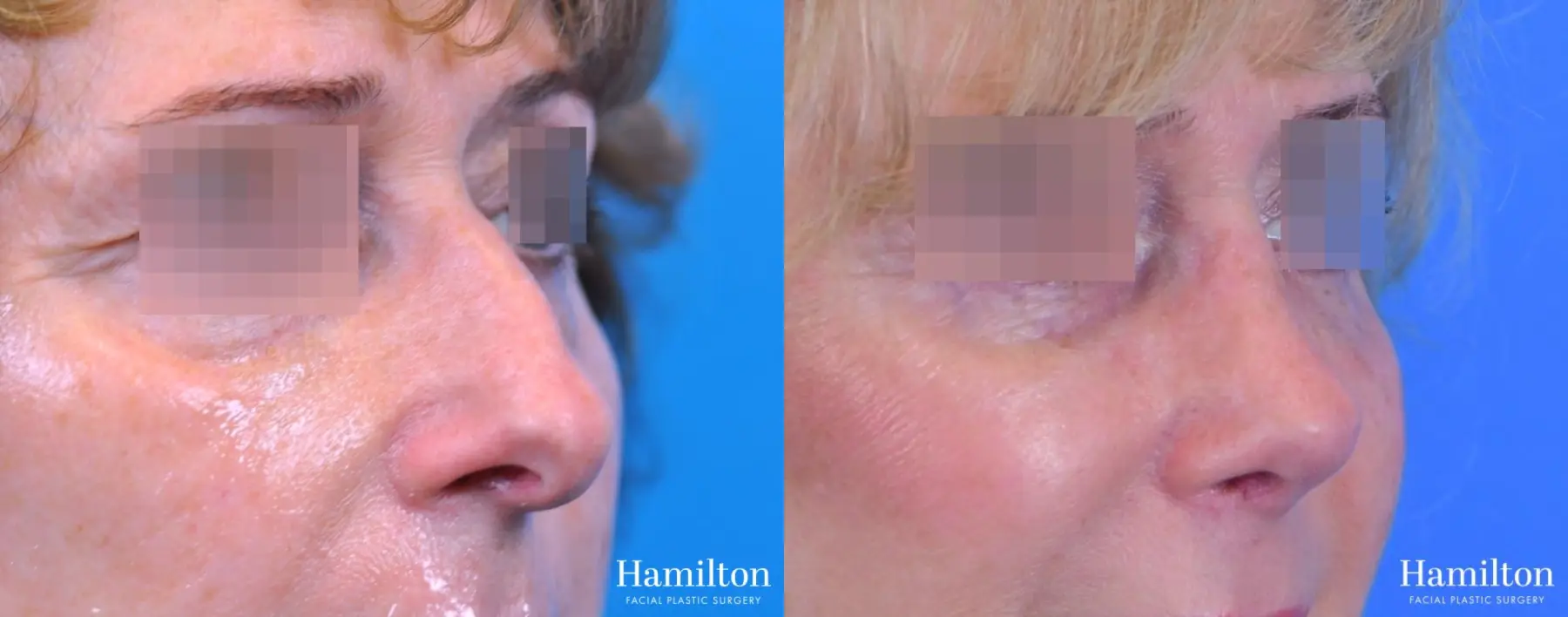 Rhinoplasty: Patient 47 - Before and After 2