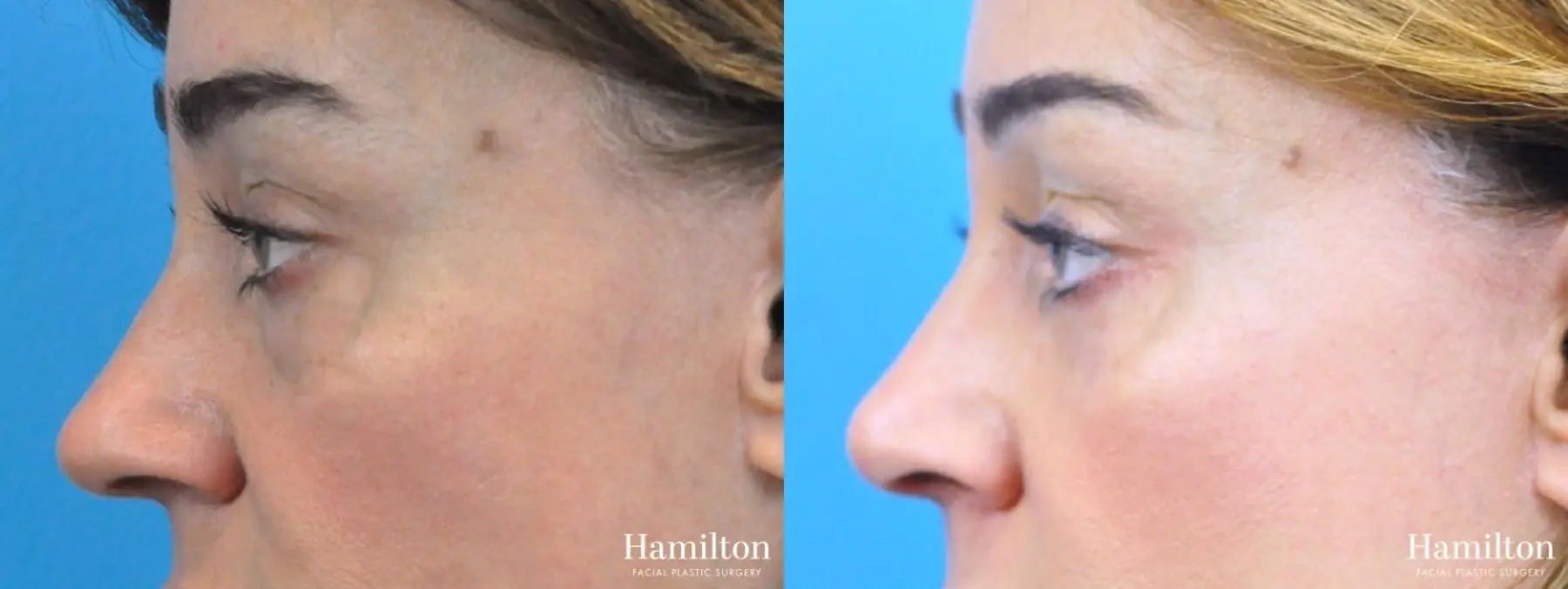 Rhinoplasty: Patient 38 - Before and After 2