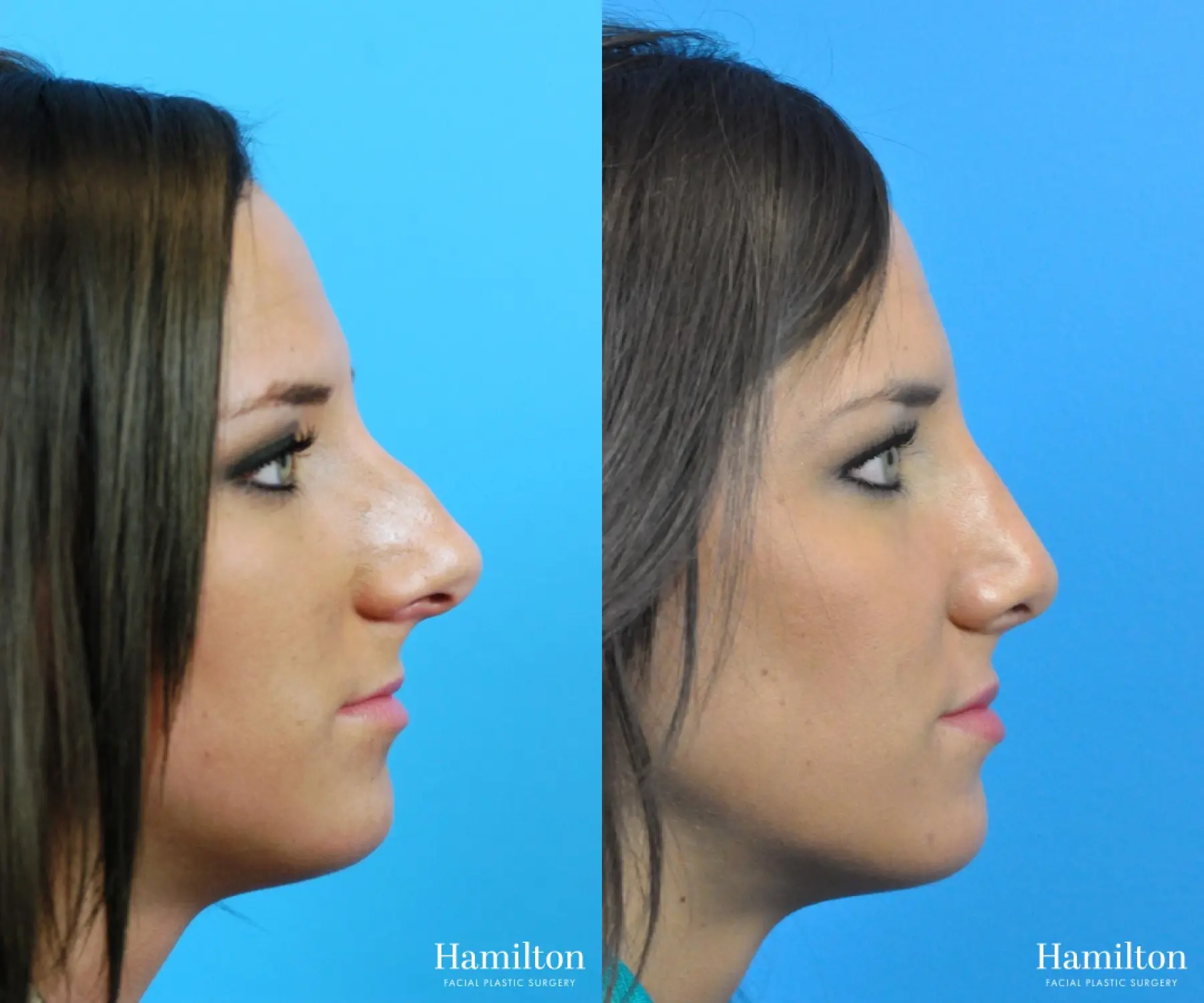 Rhinoplasty: Patient 27 - Before and After 1