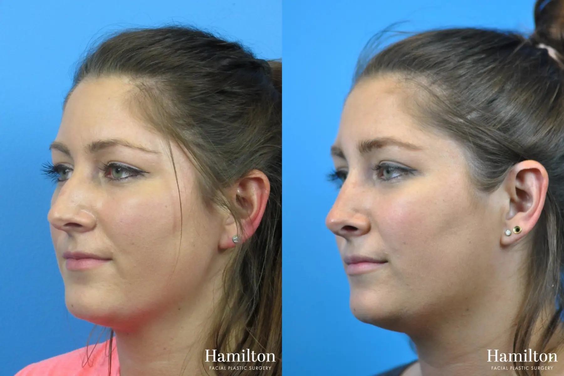 Rhinoplasty: Patient 34 - Before and After 3