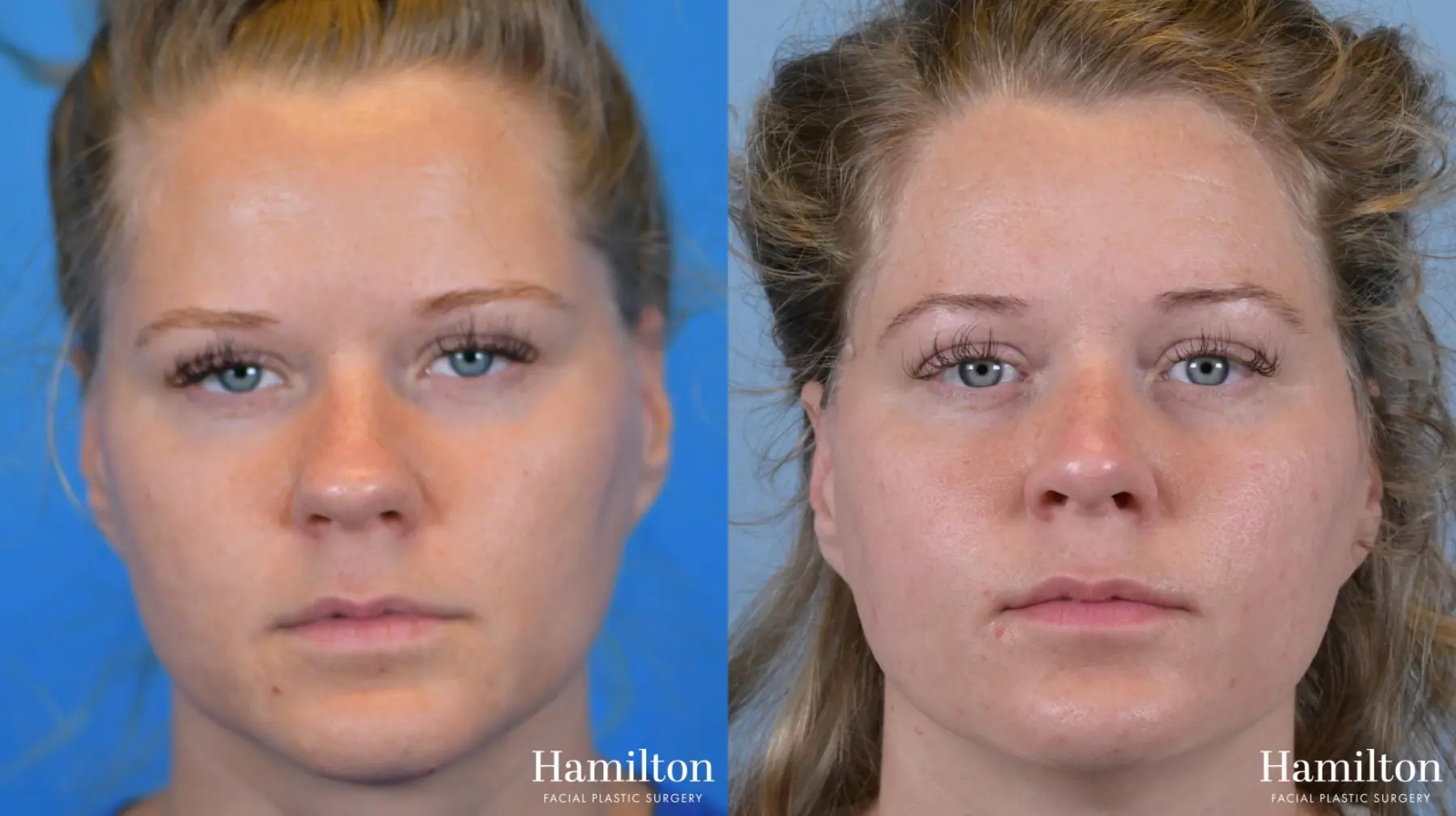 Rhinoplasty: Patient 52 - Before and After 5