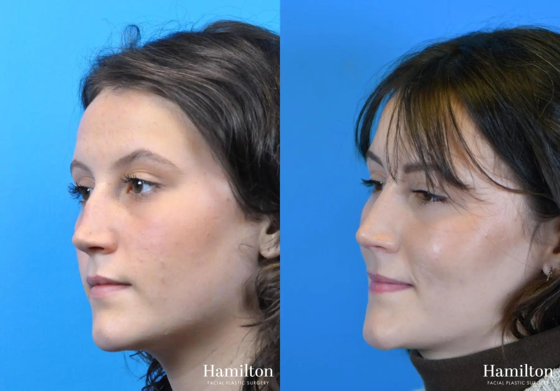 Rhinoplasty: Patient 17 - Before and After 4