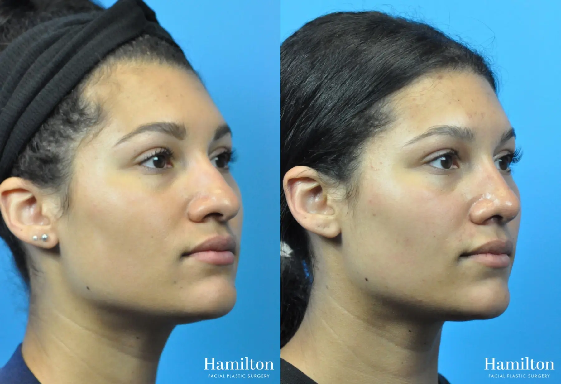 Rhinoplasty: Patient 45 - Before and After 5