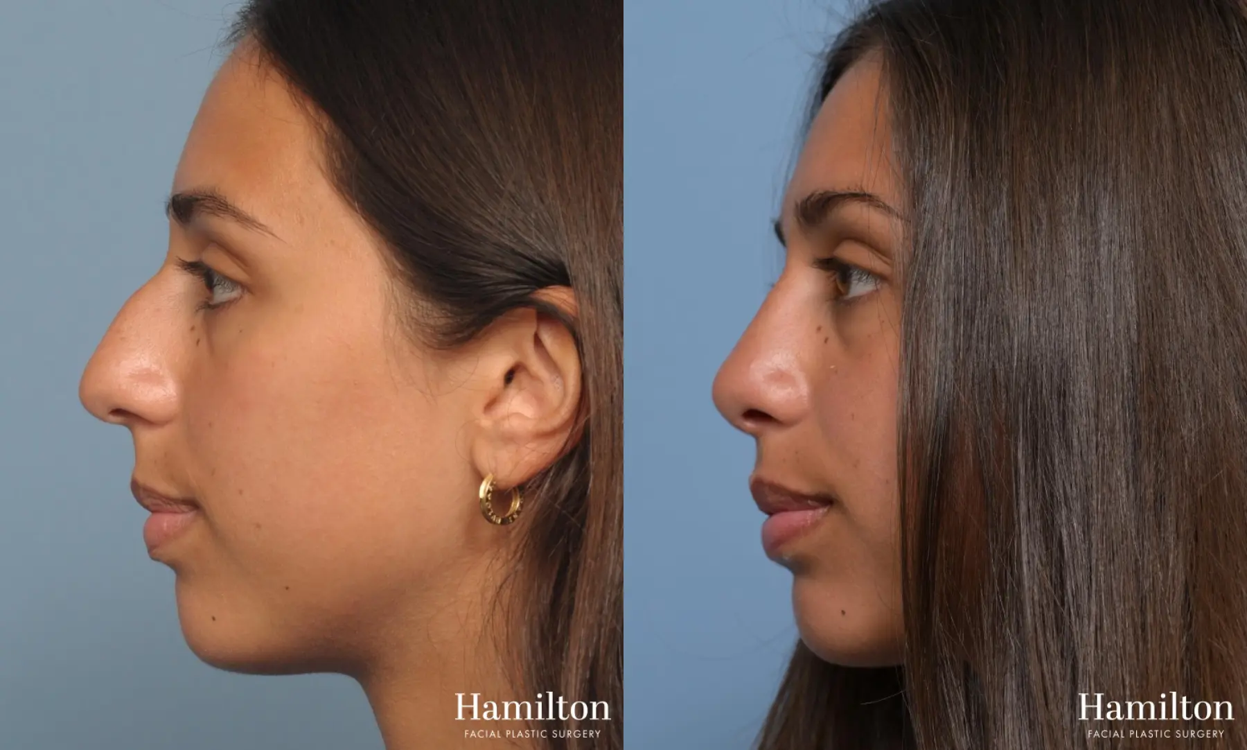 Rhinoplasty: Patient 2 - Before and After 2