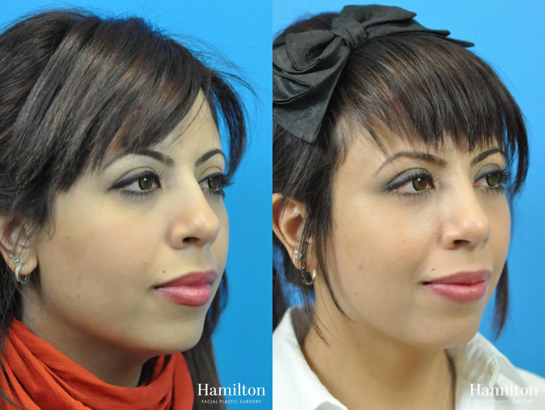 Rhinoplasty: Patient 11 - Before and After 4