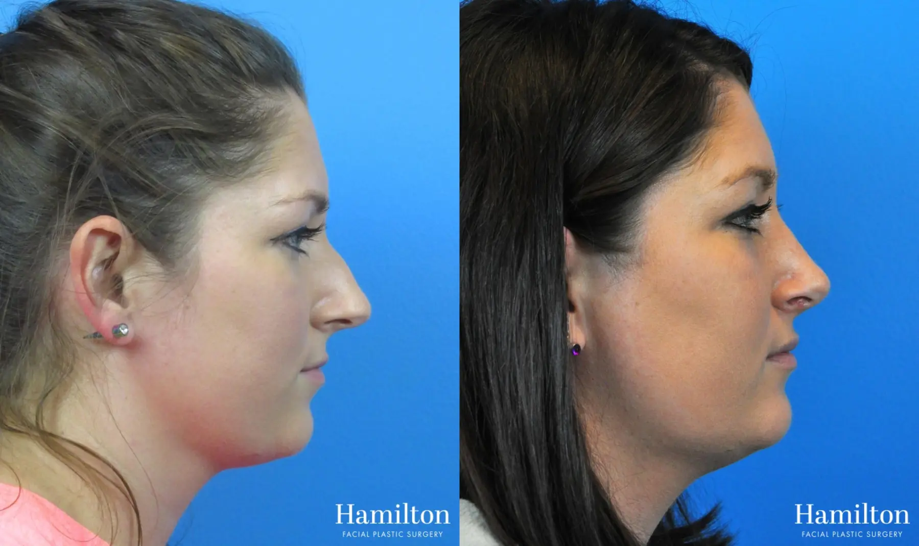 Rhinoplasty: Patient 53 - Before and After 1