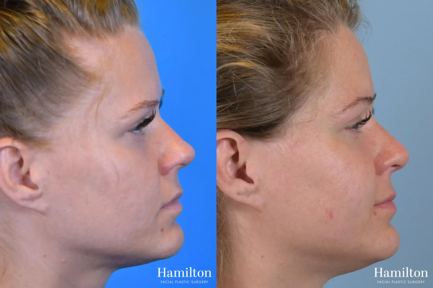 Rhinoplasty: Patient 52 - Before and After 3