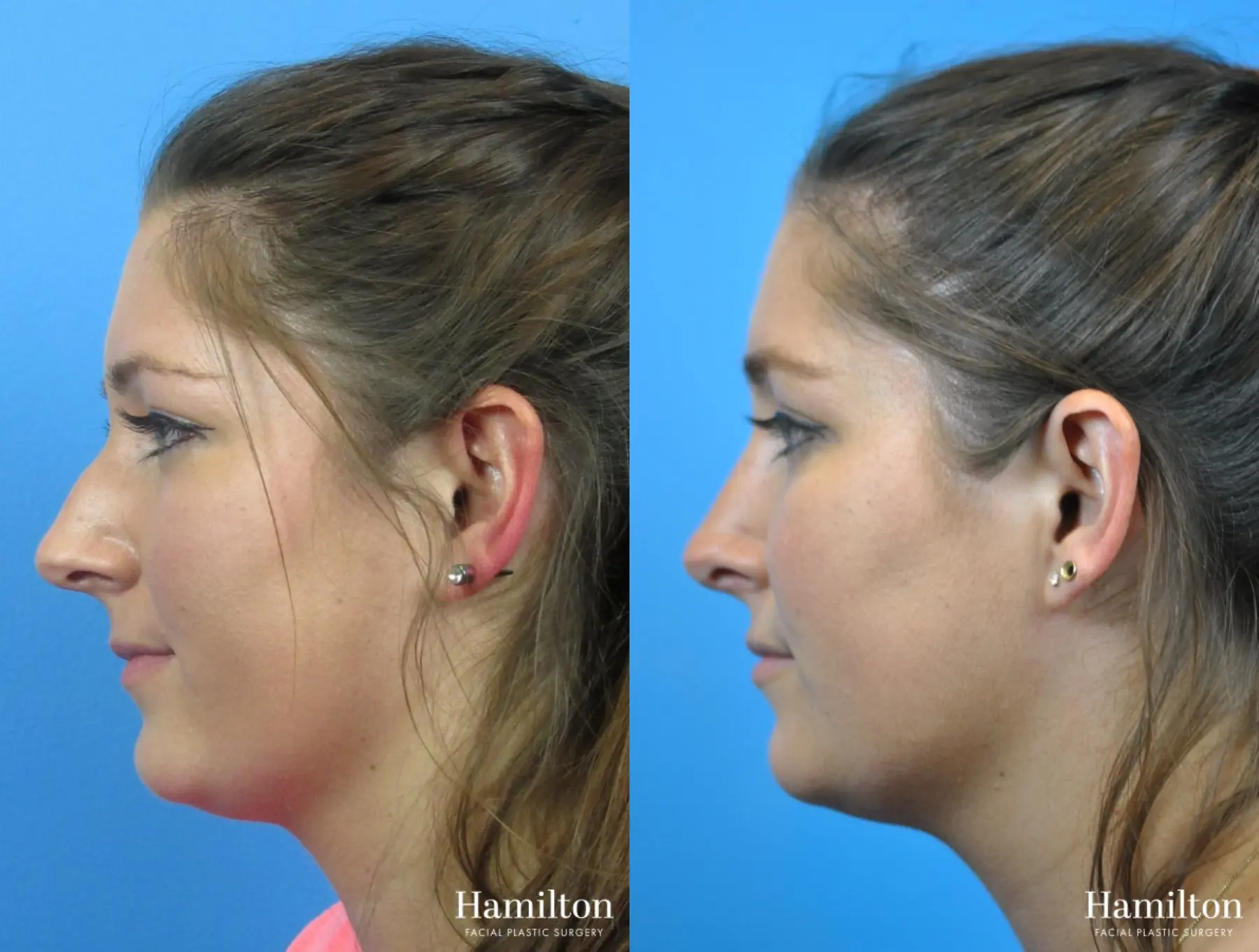 Rhinoplasty: Patient 34 - Before and After 1