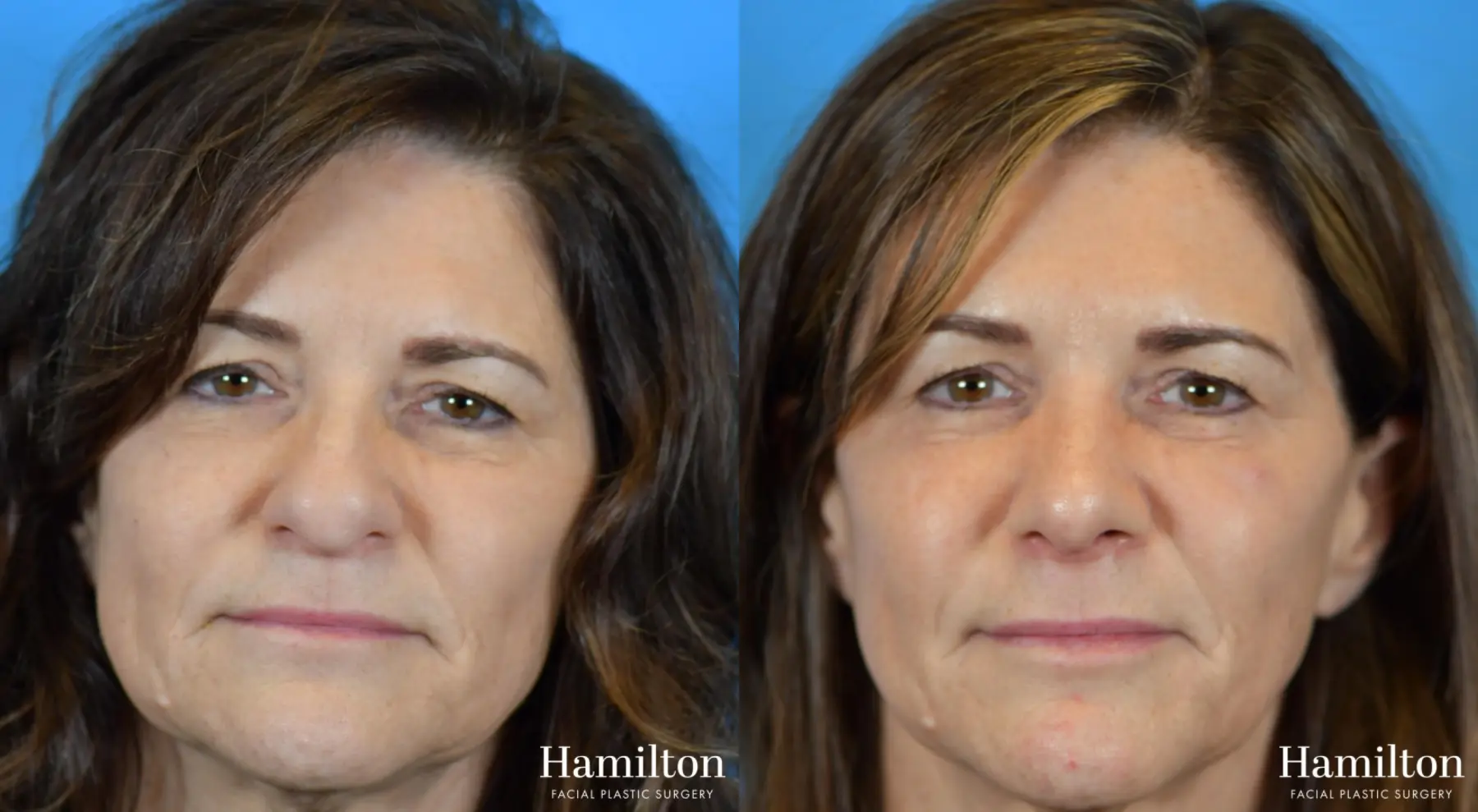 Rhinoplasty: Patient 10 - Before and After 1