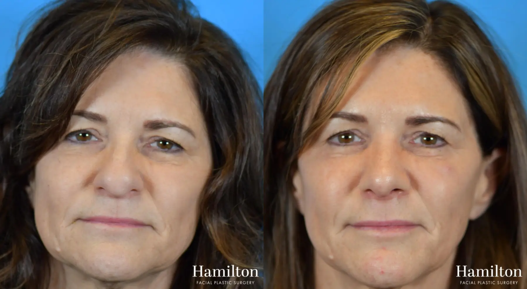 Rhinoplasty: Patient 9 - Before and After  