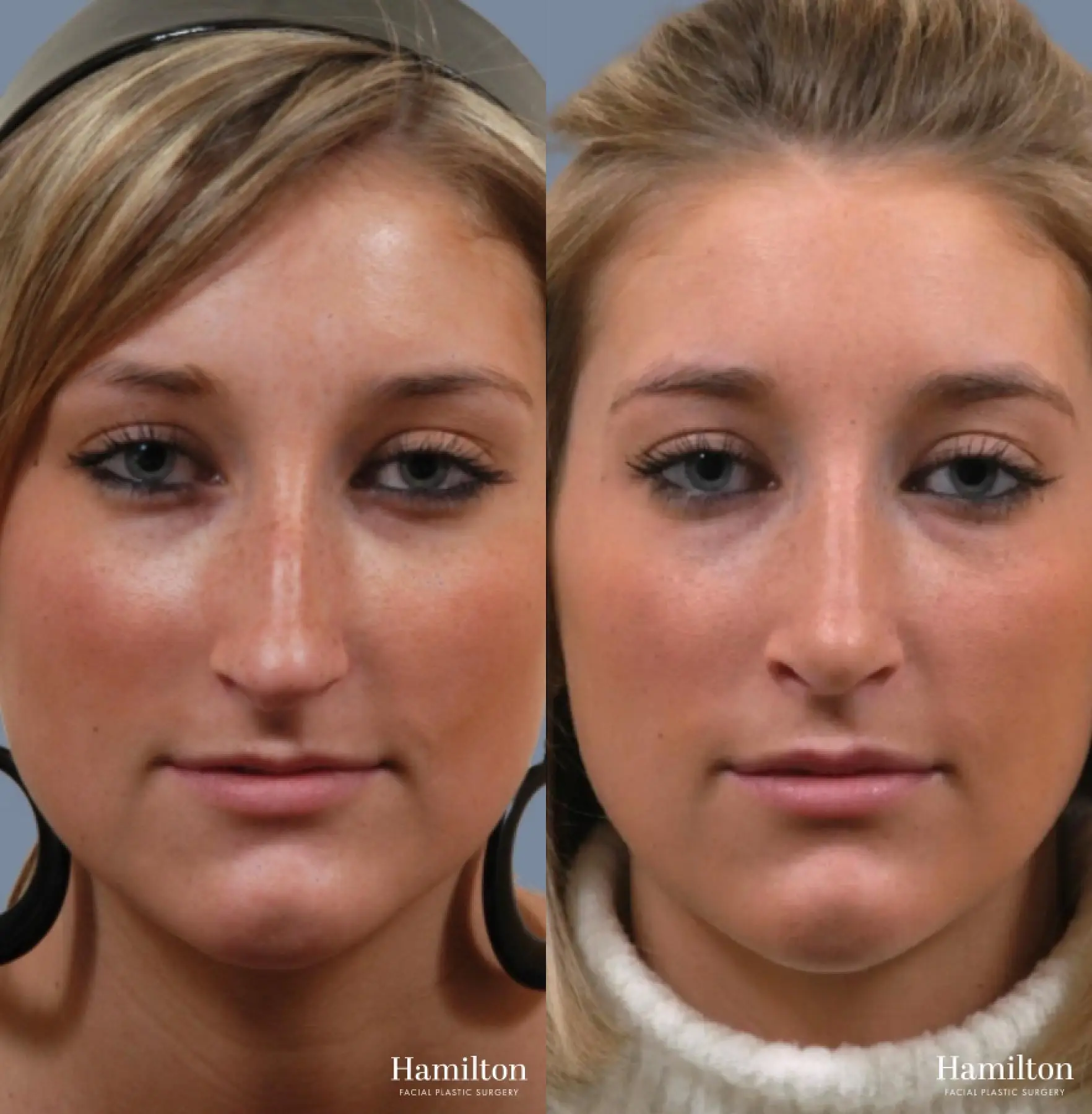 Rhinoplasty: Patient 9 - Before and After 5