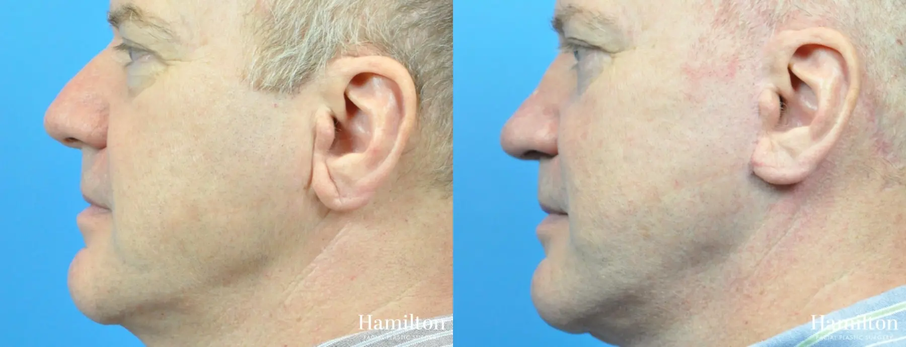 Rhinoplasty: Patient 21 - Before and After 2