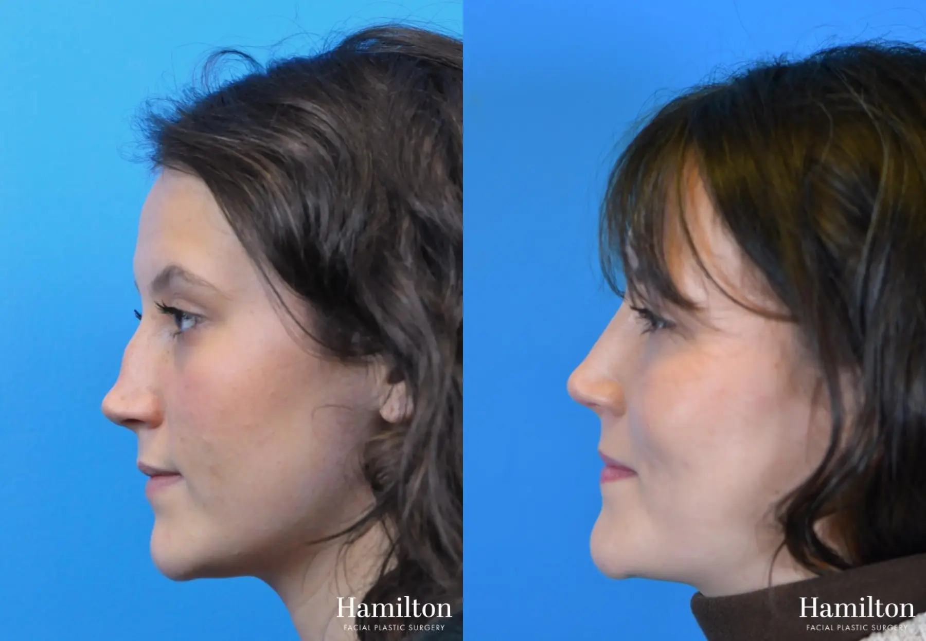 Rhinoplasty: Patient 17 - Before and After 1