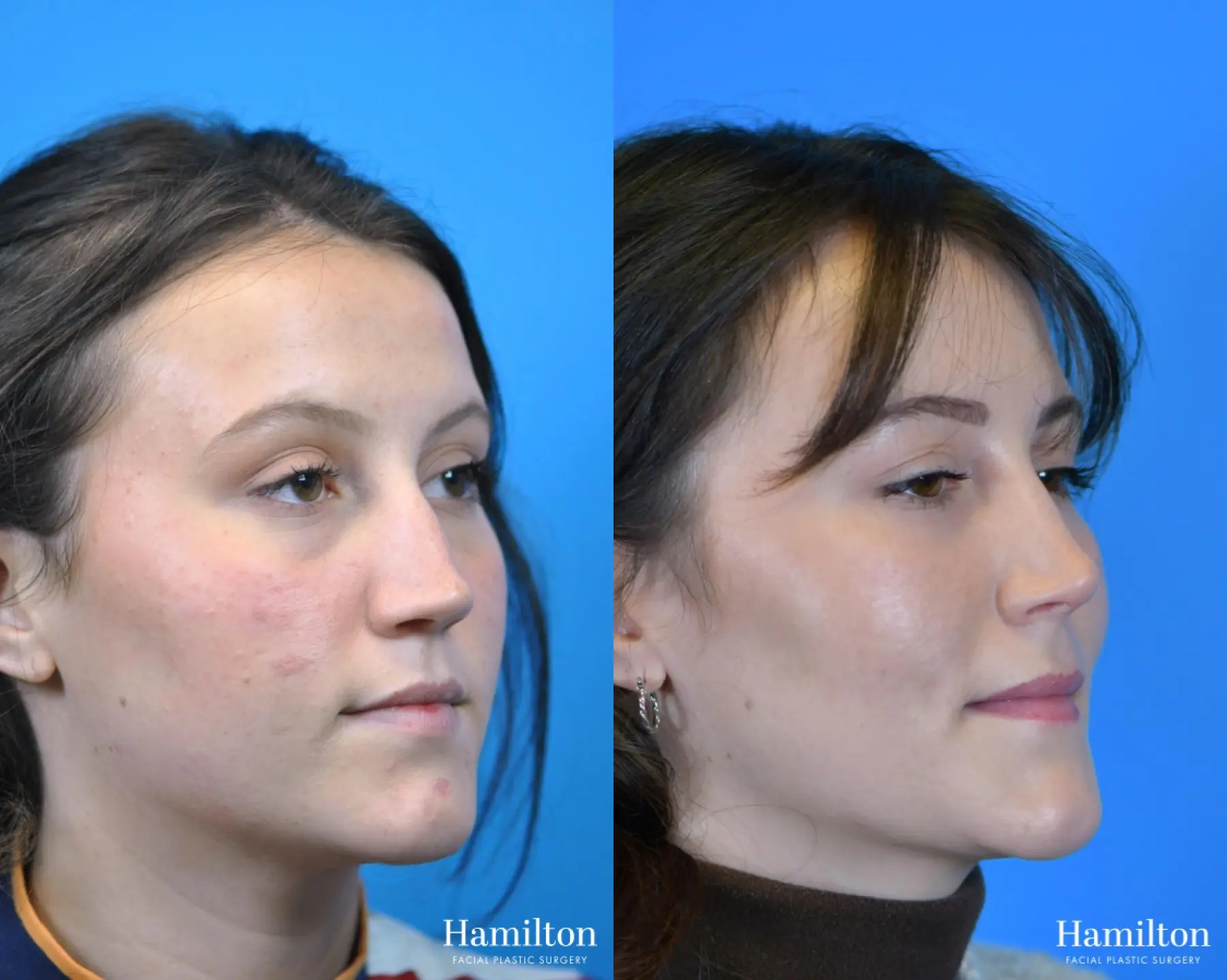 Rhinoplasty: Patient 17 - Before and After 2