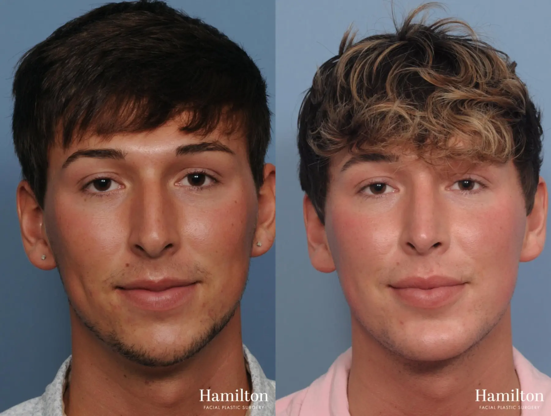 Rhinoplasty: Patient 25 - Before and After 4