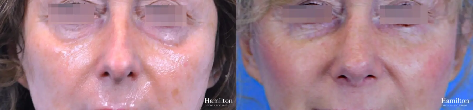 Rhinoplasty: Patient 47 - Before and After 4