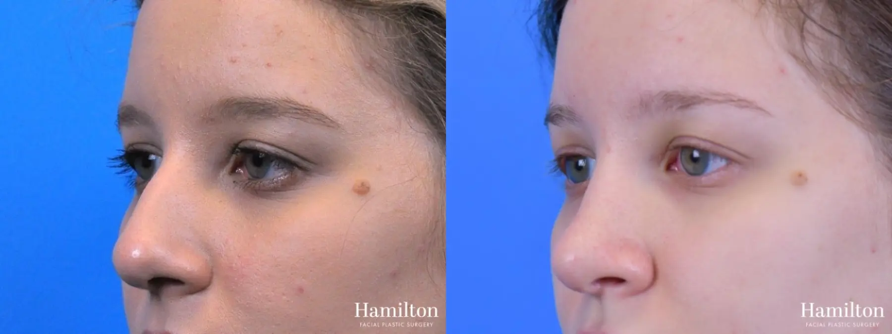Rhinoplasty: Patient 20 - Before and After 4