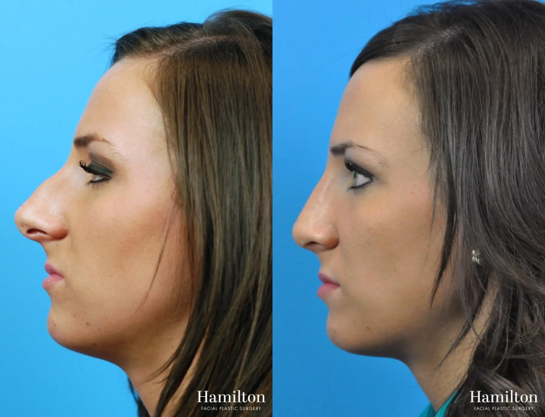 Rhinoplasty: Patient 27 - Before and After 2