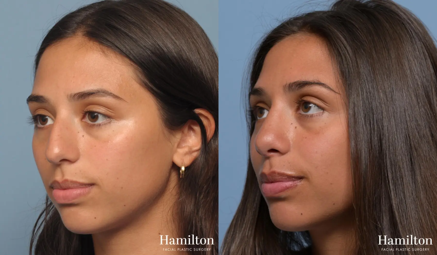 Rhinoplasty: Patient 2 - Before and After 3