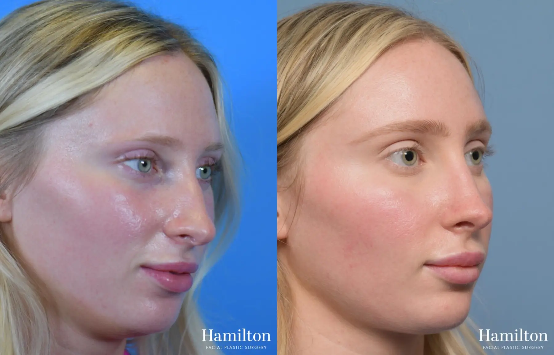 Rhinoplasty: Patient 4 - Before and After 2