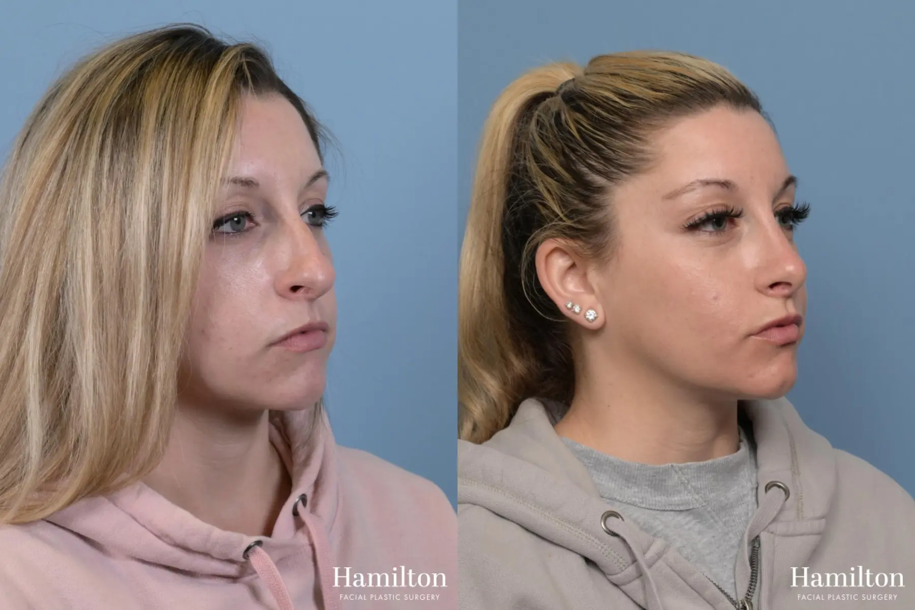 Rhinoplasty: Patient 11 - Before and After 3
