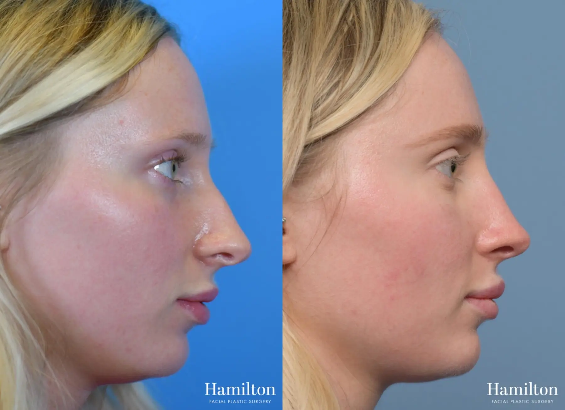 Rhinoplasty: Patient 4 - Before and After 1