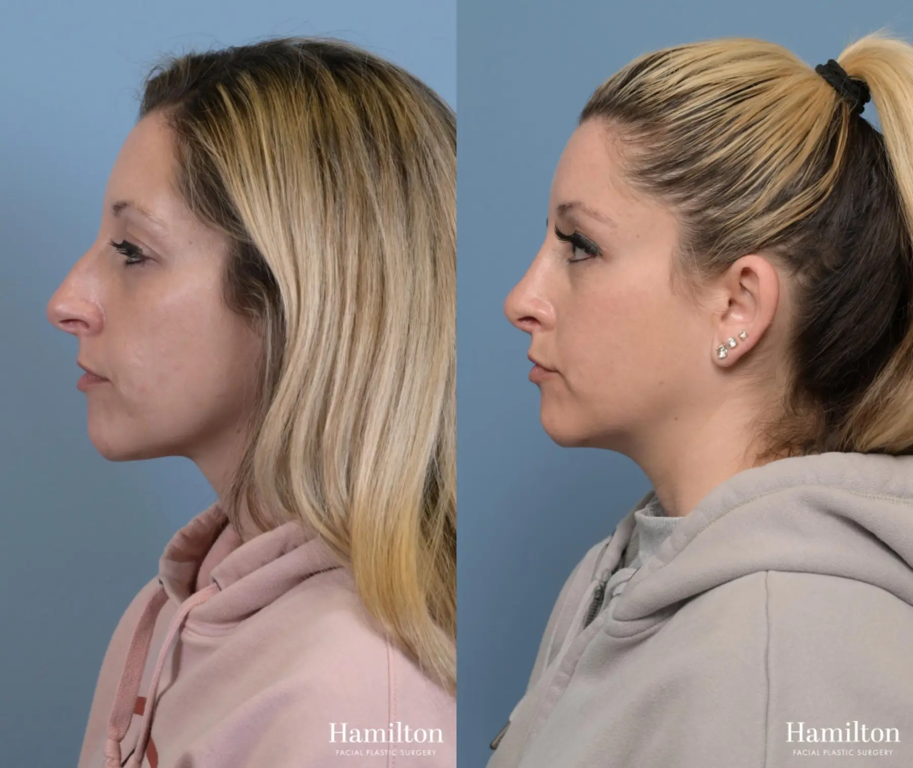 Rhinoplasty: Patient 11 - Before and After 1