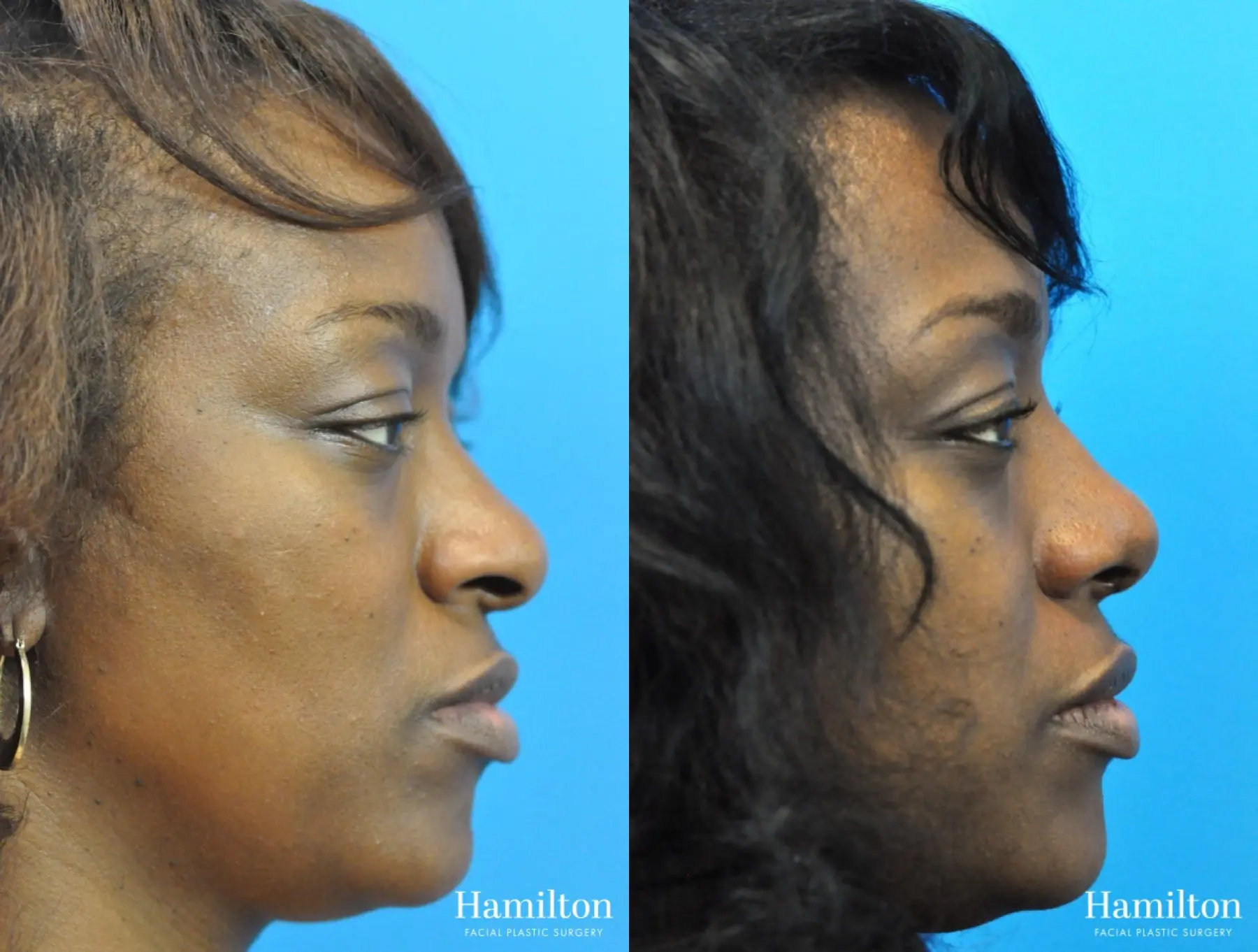 Rhinoplasty: Patient 28 - Before and After 2