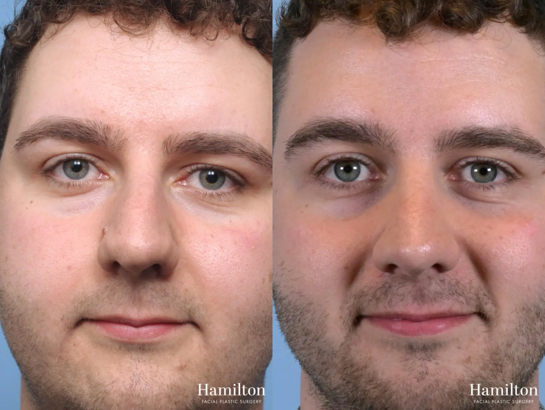 Rhinoplasty: Patient 10 - Before and After 5