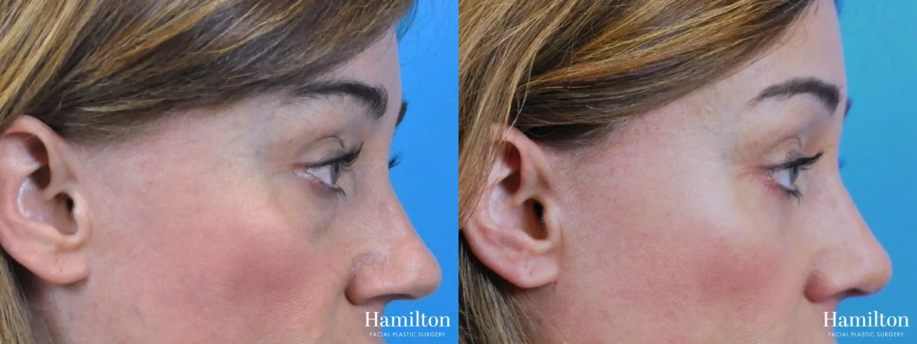 Rhinoplasty: Patient 38 - Before and After 4