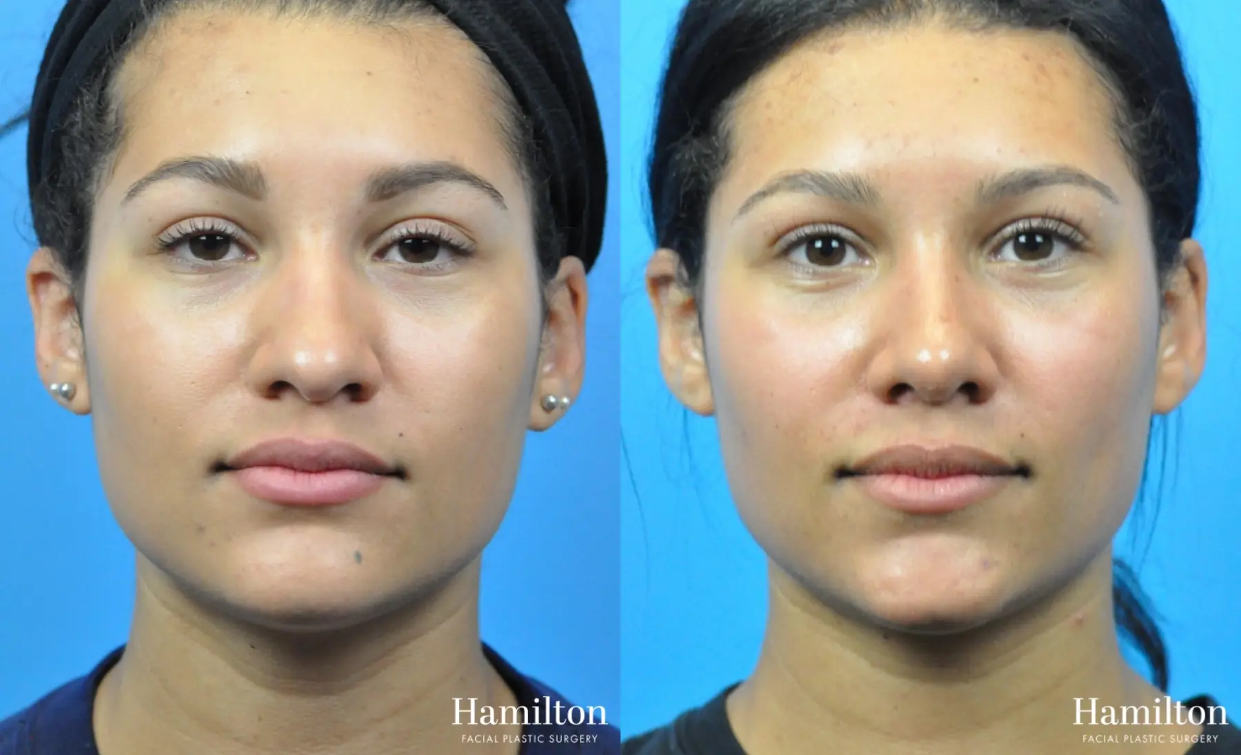 Rhinoplasty: Patient 45 - Before and After 1