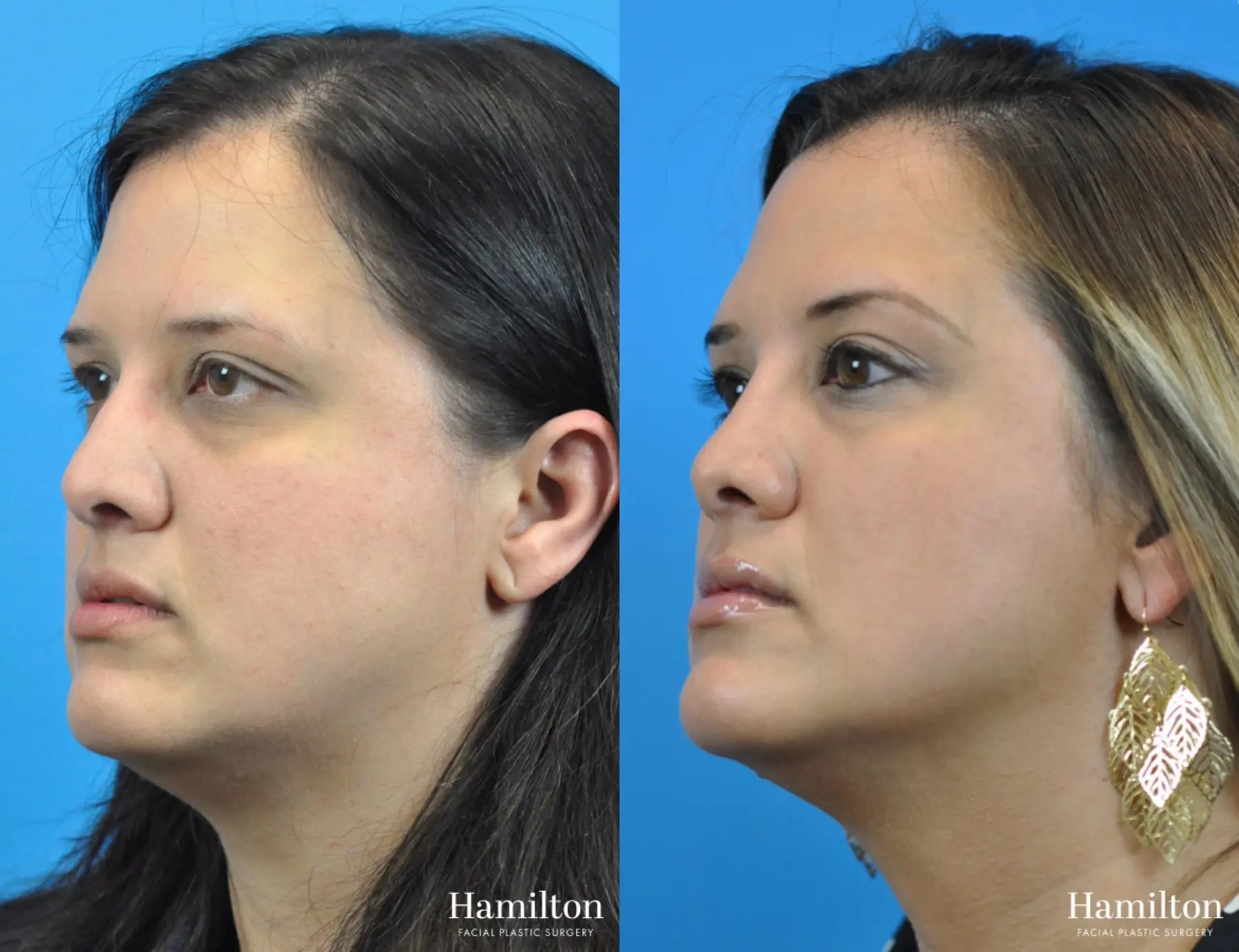 Rhinoplasty: Patient 41 - Before and After 4