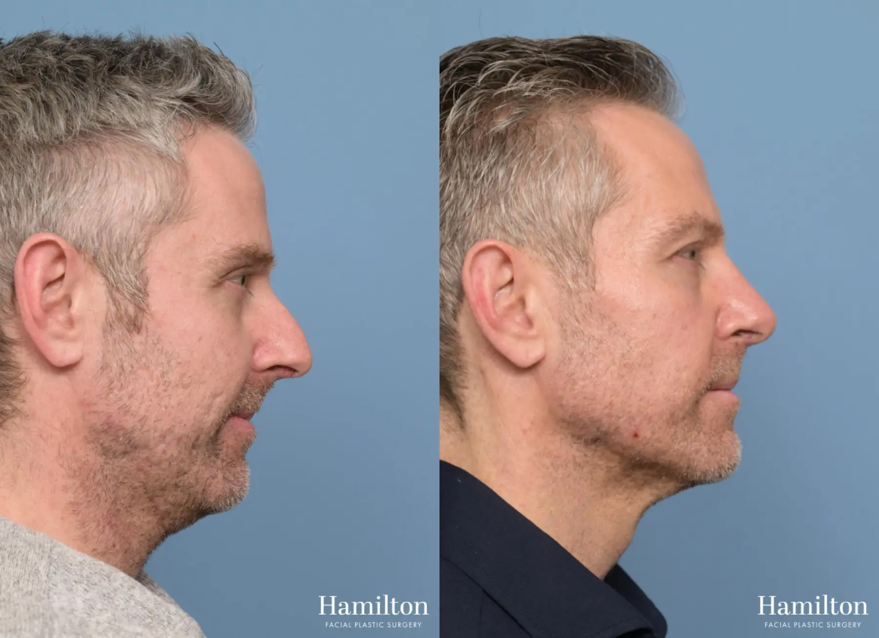 Rhinoplasty: Patient 3 - Before and After  