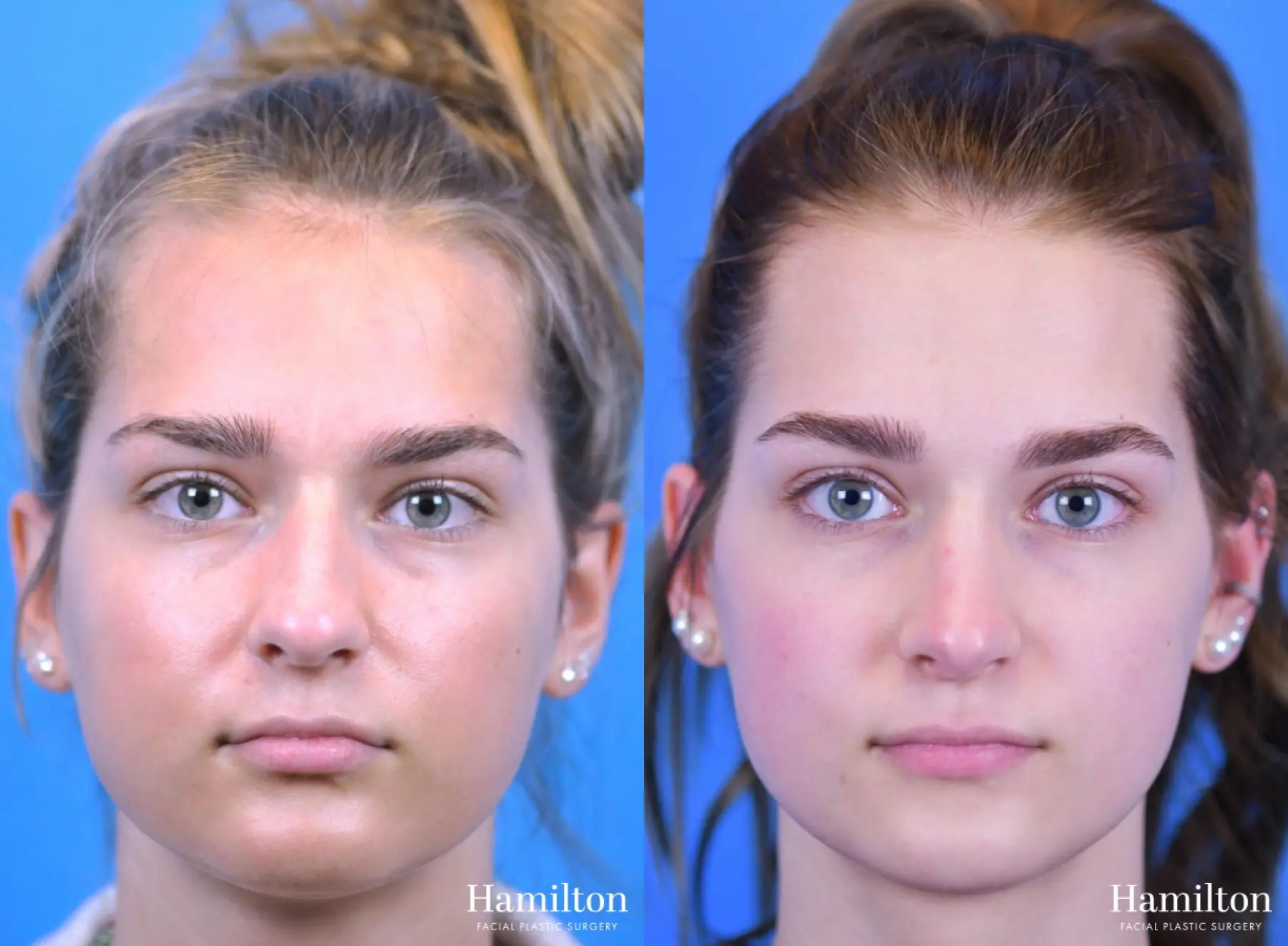 Rhinoplasty: Patient 13 - Before and After 5