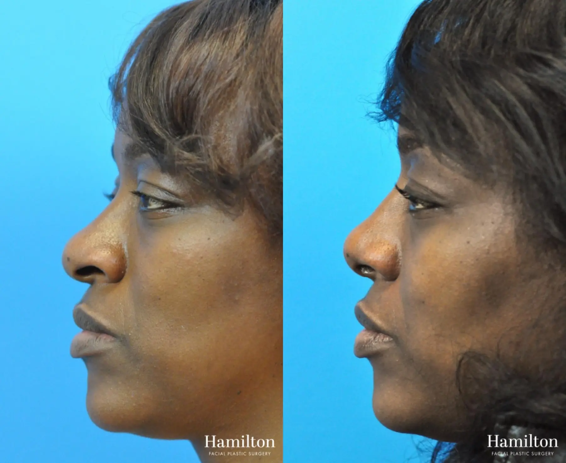 Rhinoplasty: Patient 28 - Before and After 1