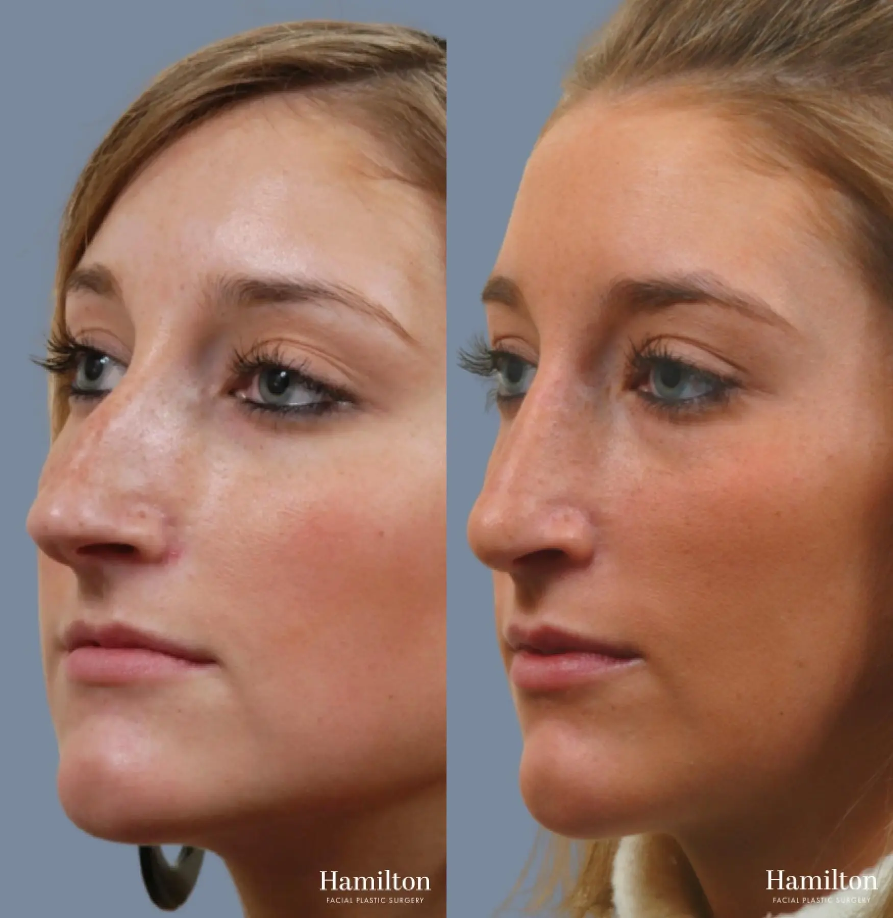 Rhinoplasty Before & After Gallery Patient 7