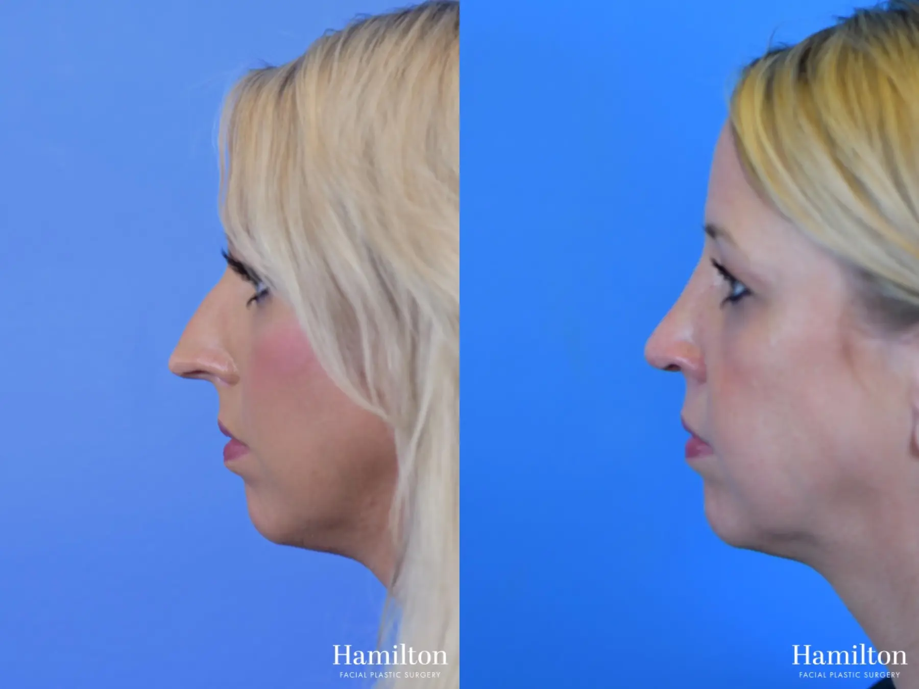 Rhinoplasty: Patient 4 - Before and After  