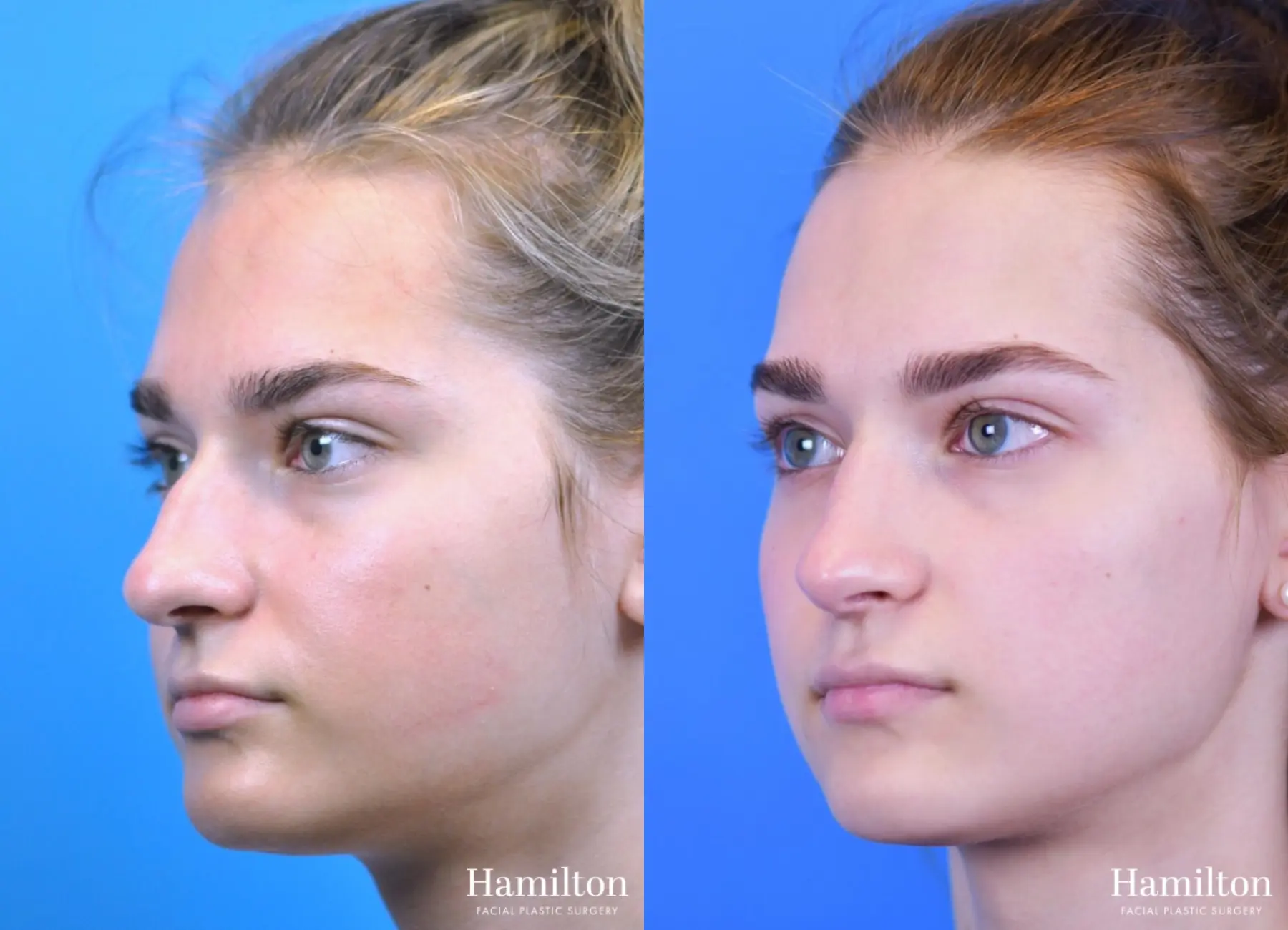 Rhinoplasty: Patient 13 - Before and After 4