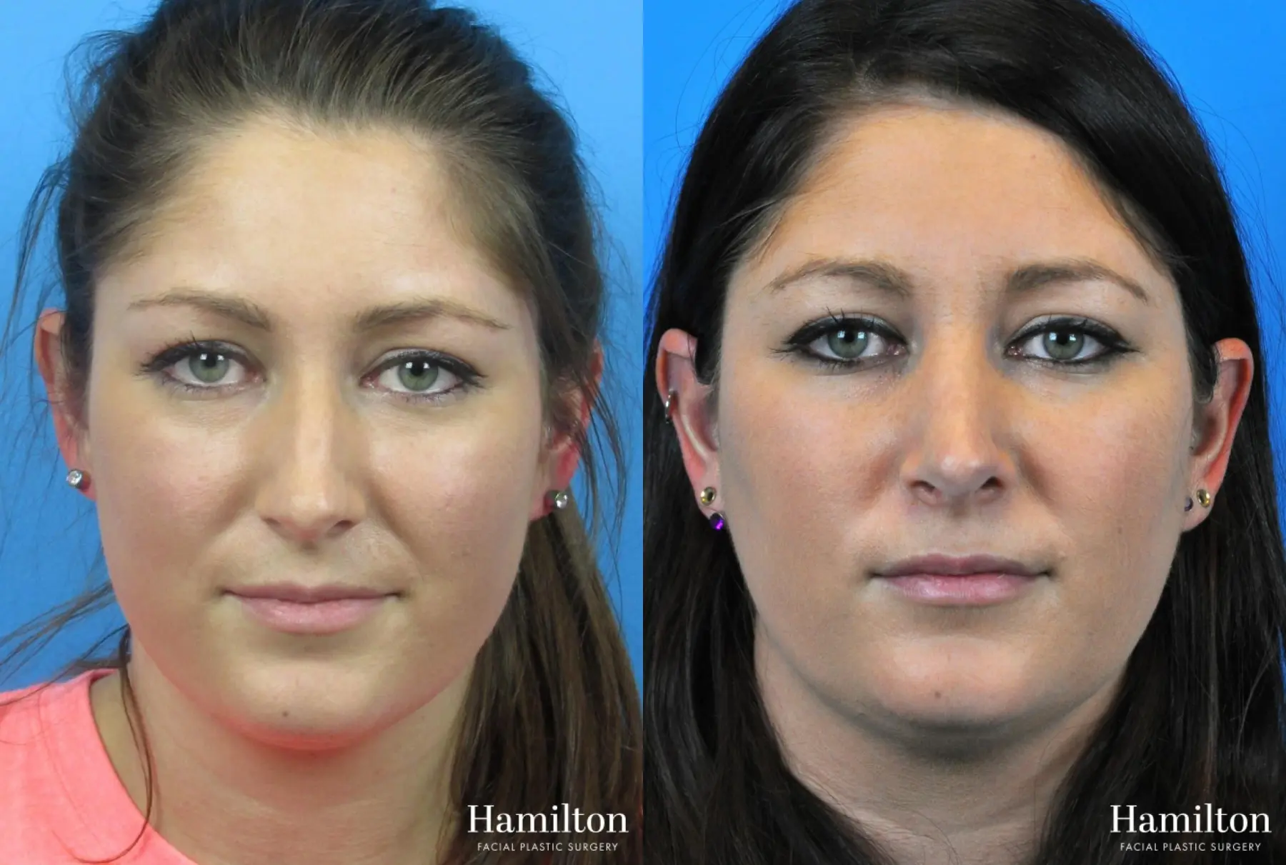 Rhinoplasty: Patient 53 - Before and After 5