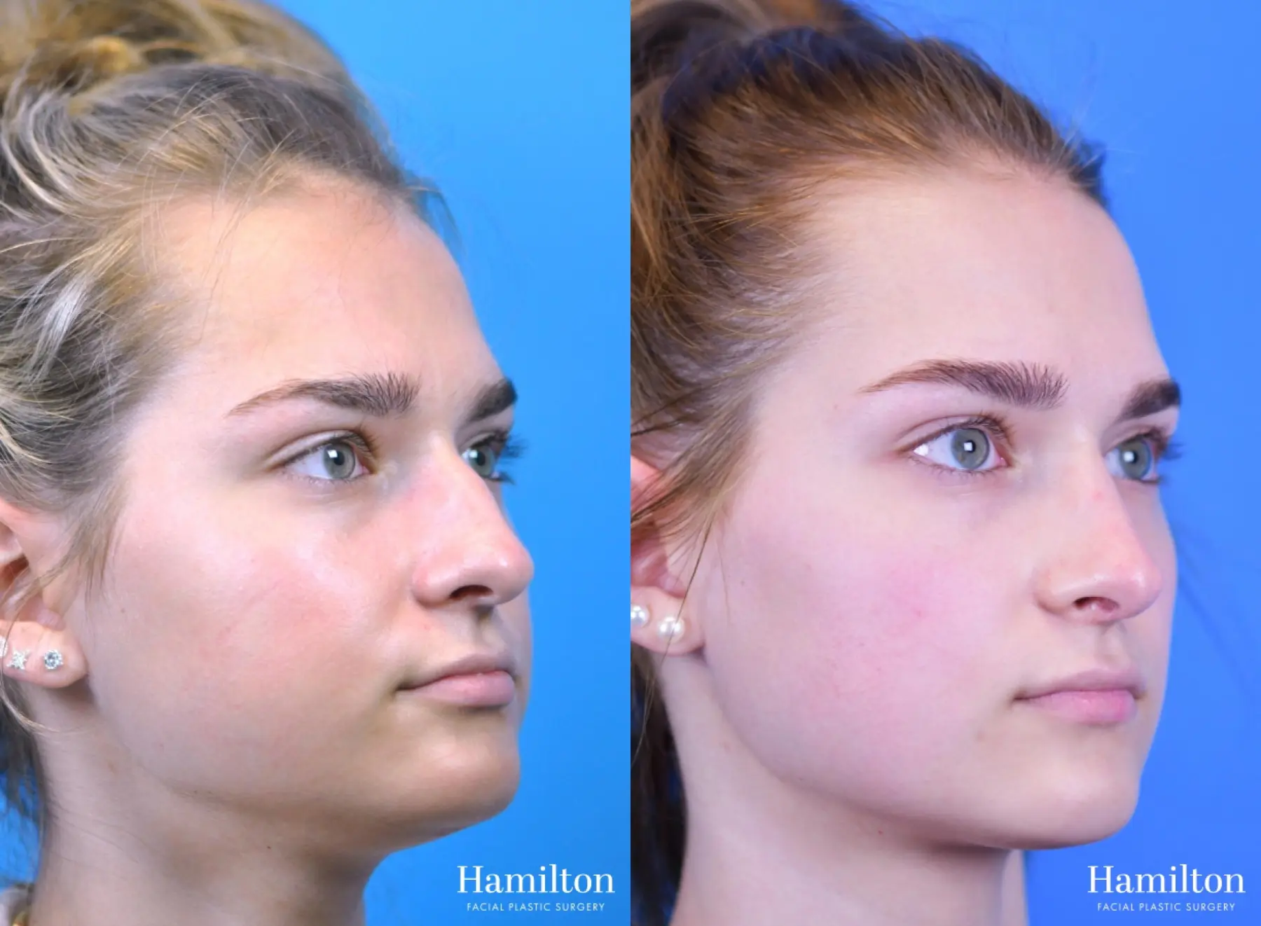 Rhinoplasty: Patient 13 - Before and After 2
