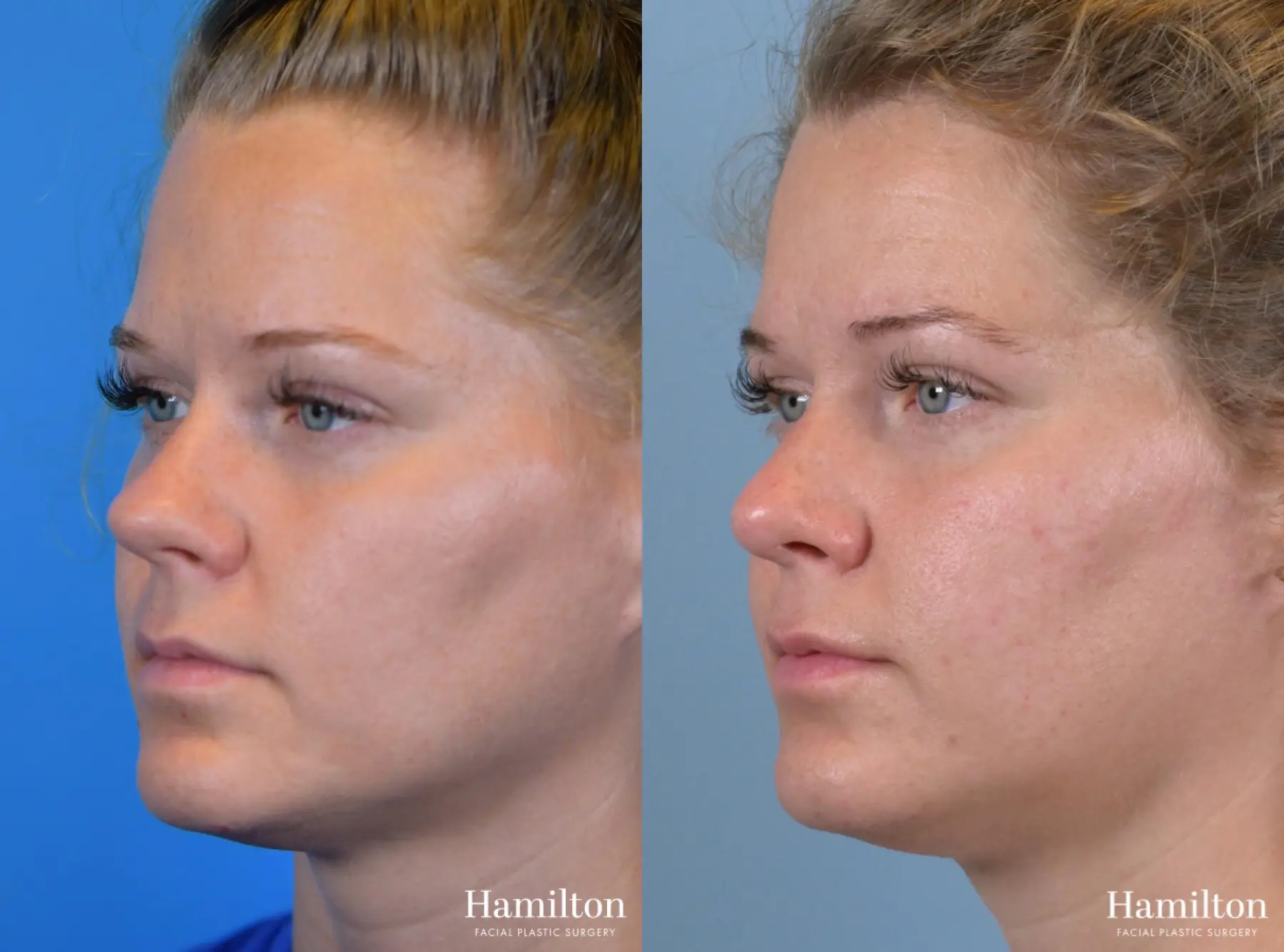 Rhinoplasty: Patient 52 - Before and After 2