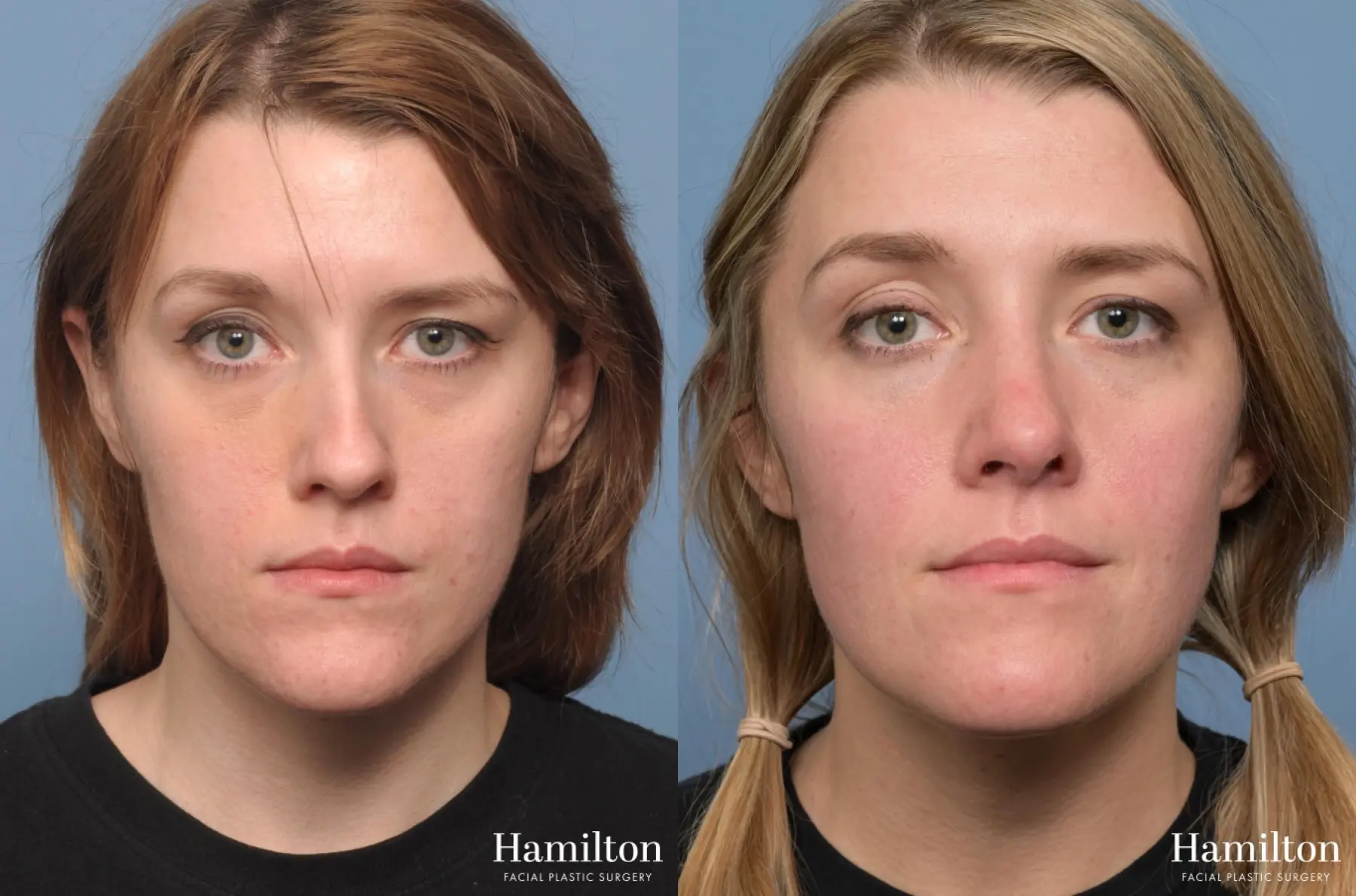 Rhinoplasty: Patient 3 - Before and After 4