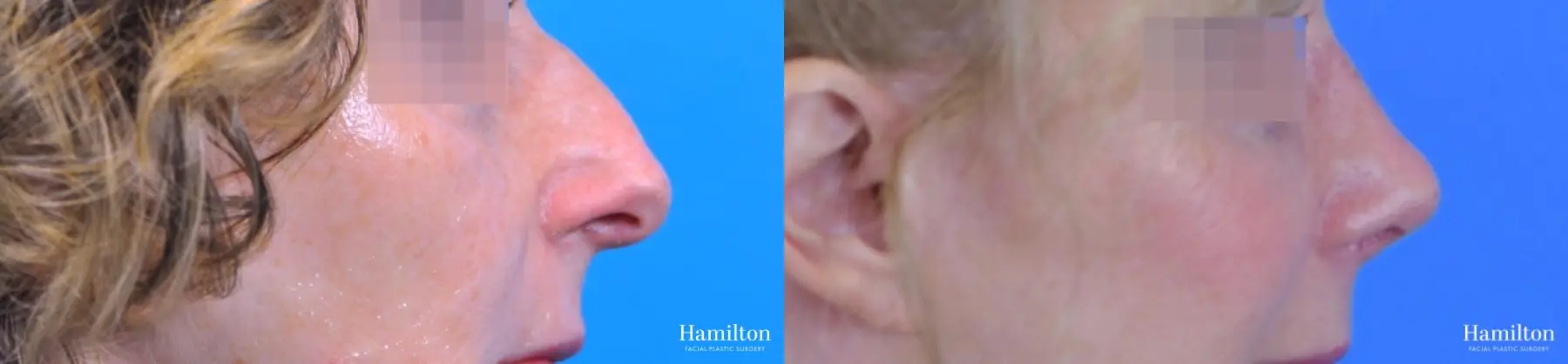 Rhinoplasty: Patient 47 - Before and After 1