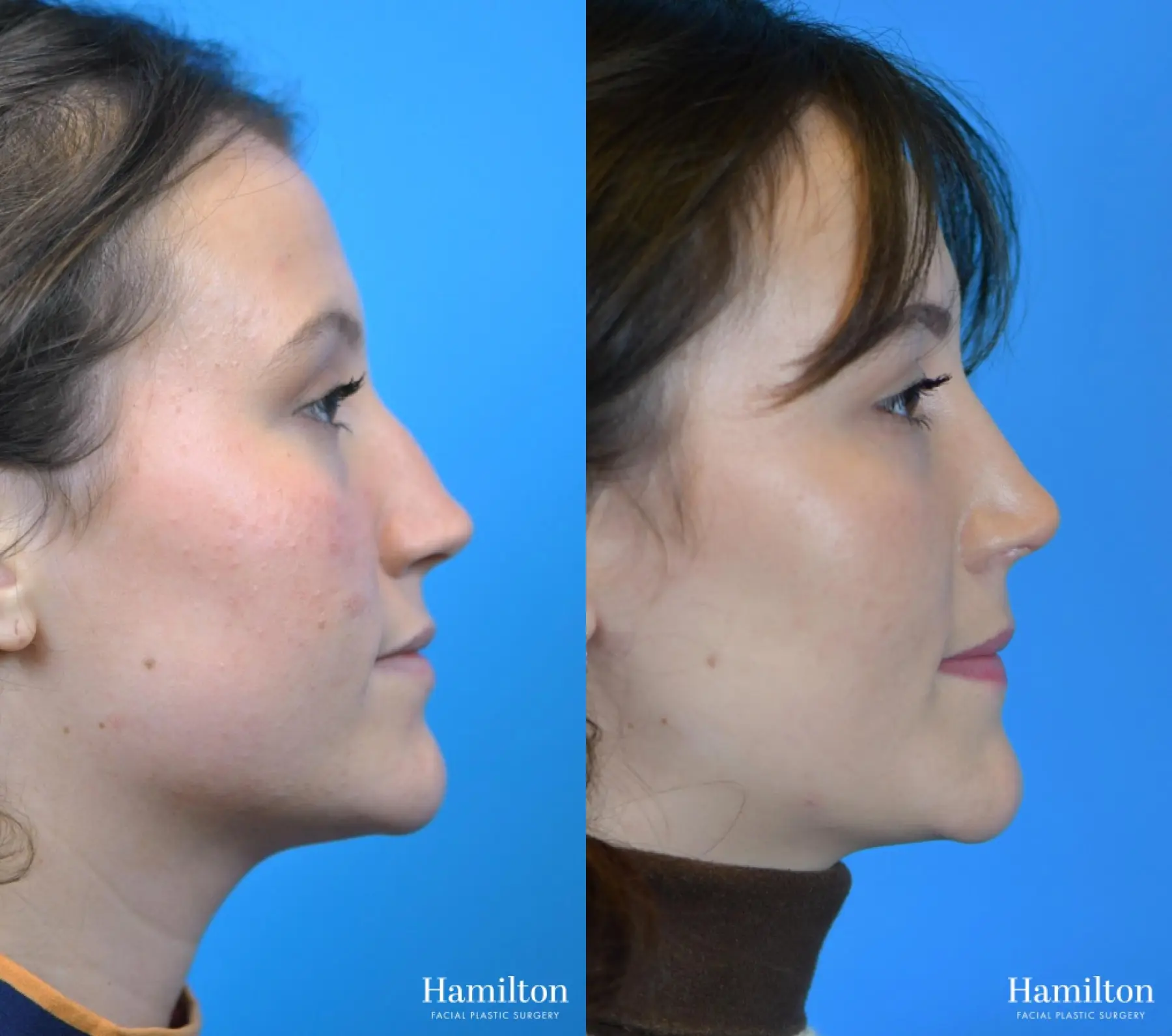 Rhinoplasty: Patient 17 - Before and After 3
