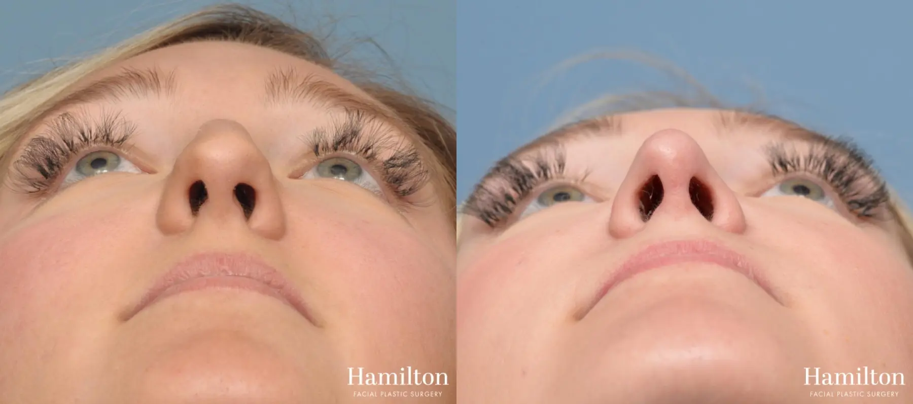 Rhinoplasty: Patient 7 - Before and After 3